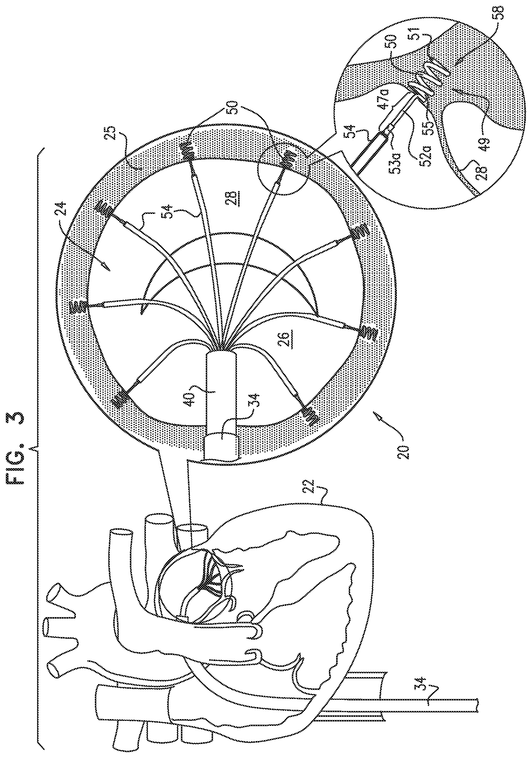 Patent US12097118 Figure 5 – Tissue anchor for heart implant