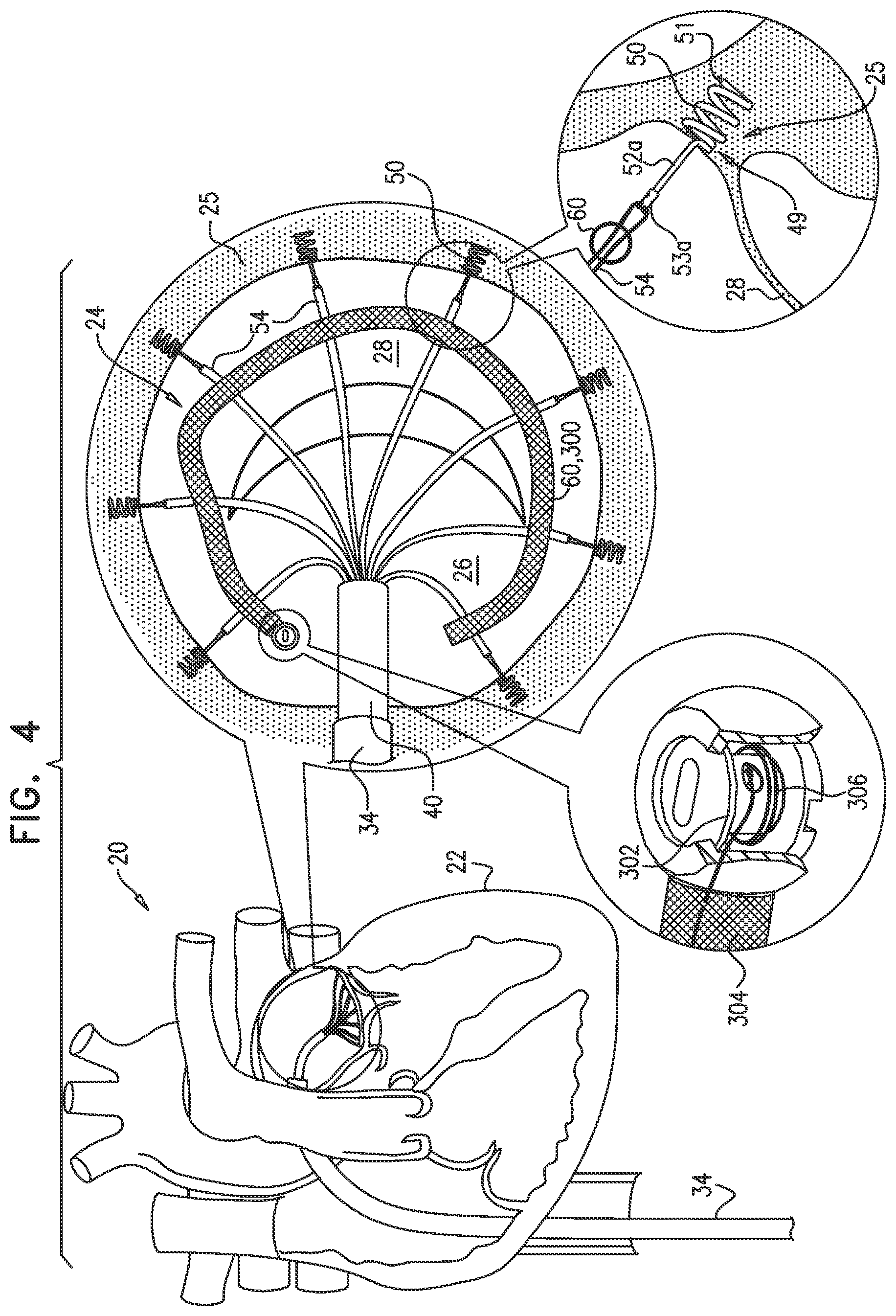 Patent US12097118 Figure 6 – Tissue anchor for heart implant