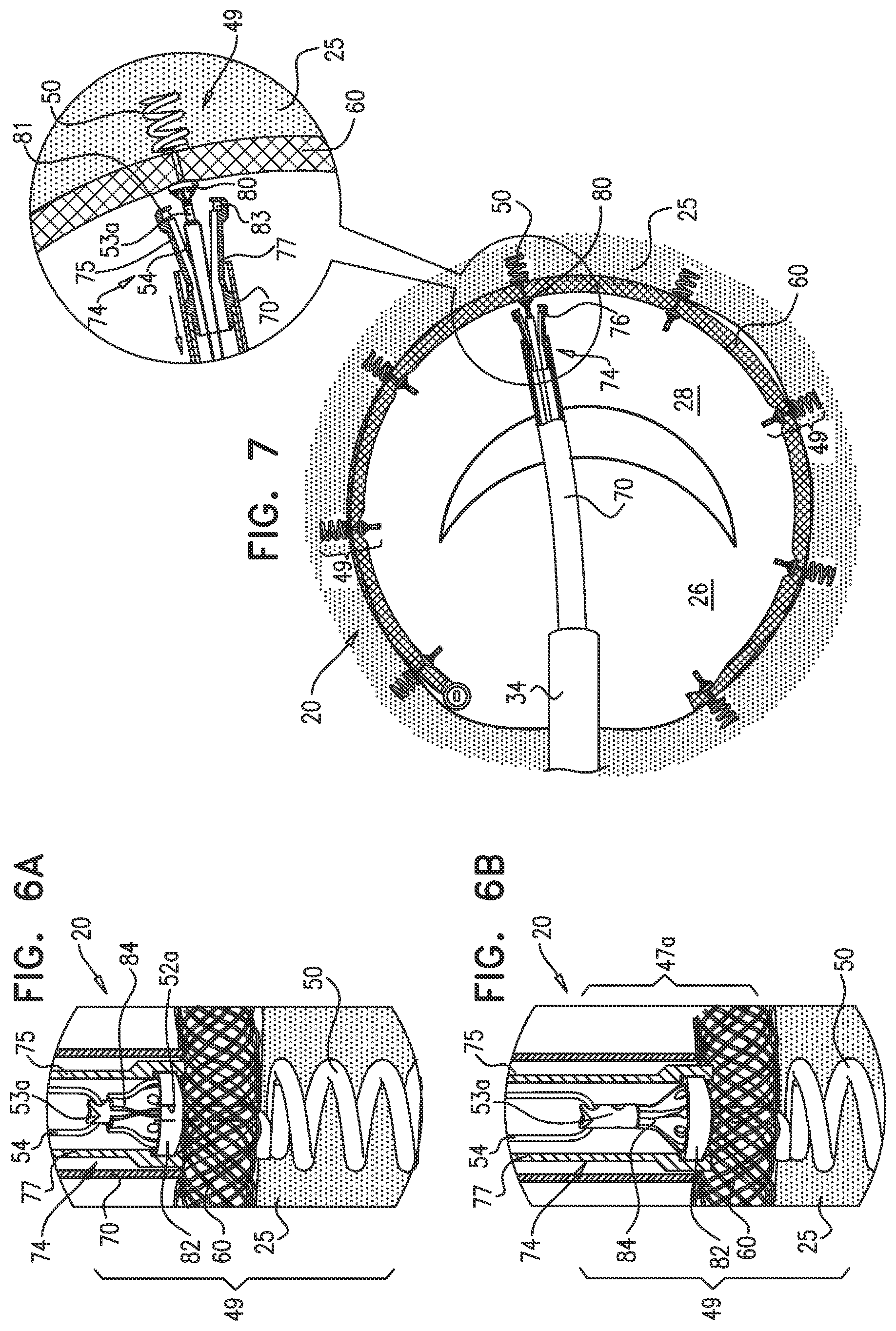 Patent US12097118 Figure 8 – Tissue anchor for heart implant