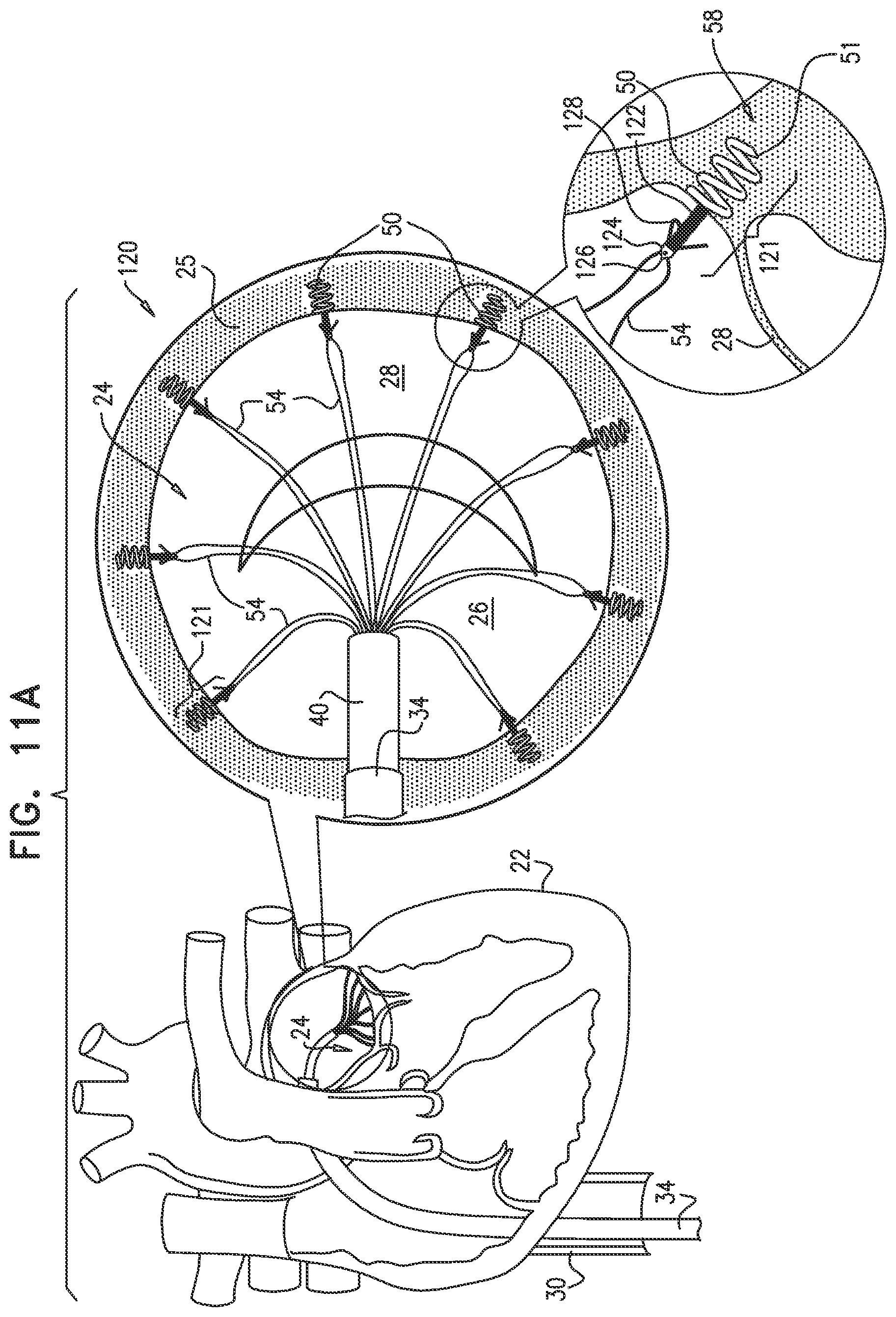 Patent US12097118 Figure 11 – Tissue anchor for heart implant
