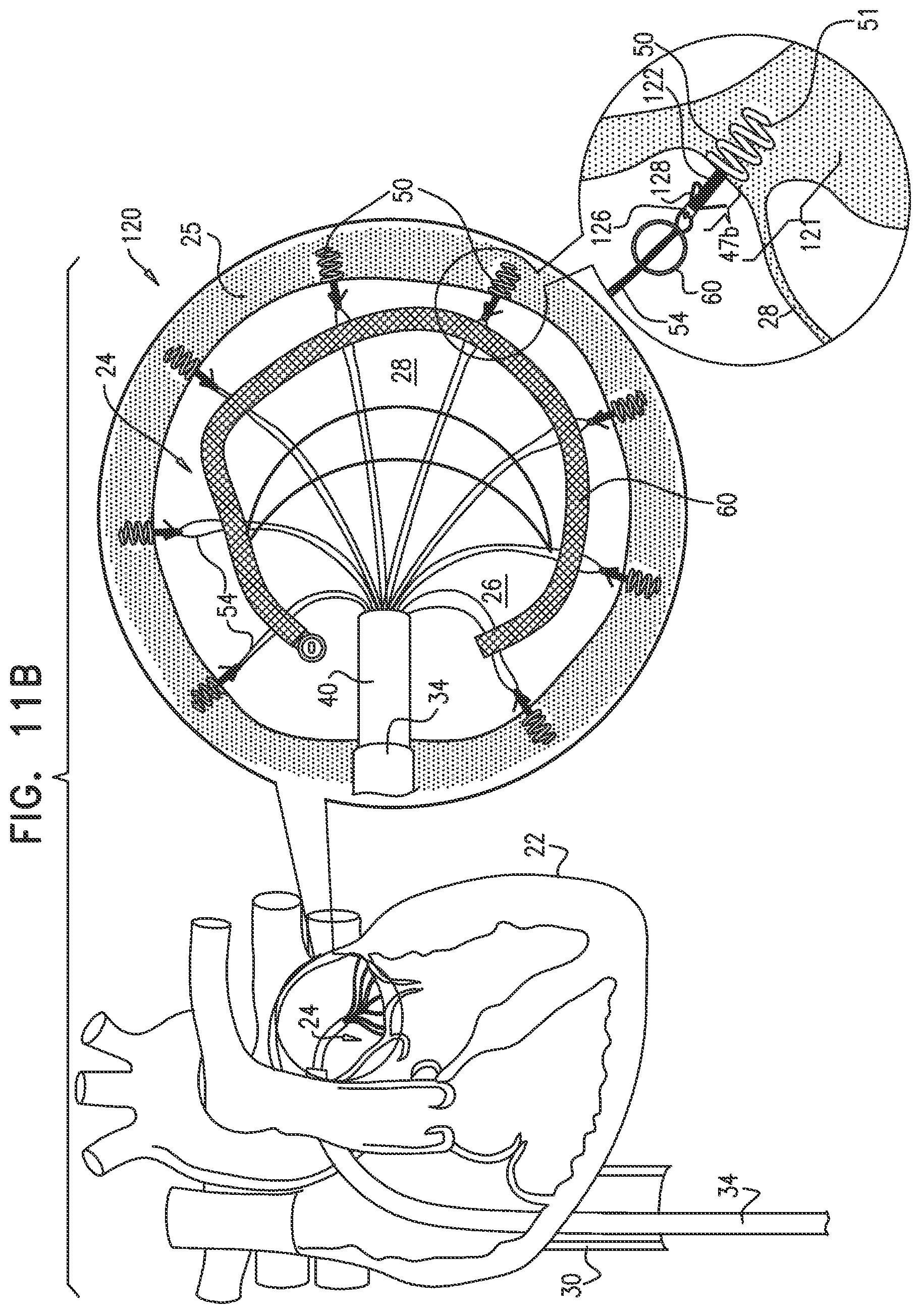 Patent US12097118 Figure 12 – Tissue anchor for heart implant