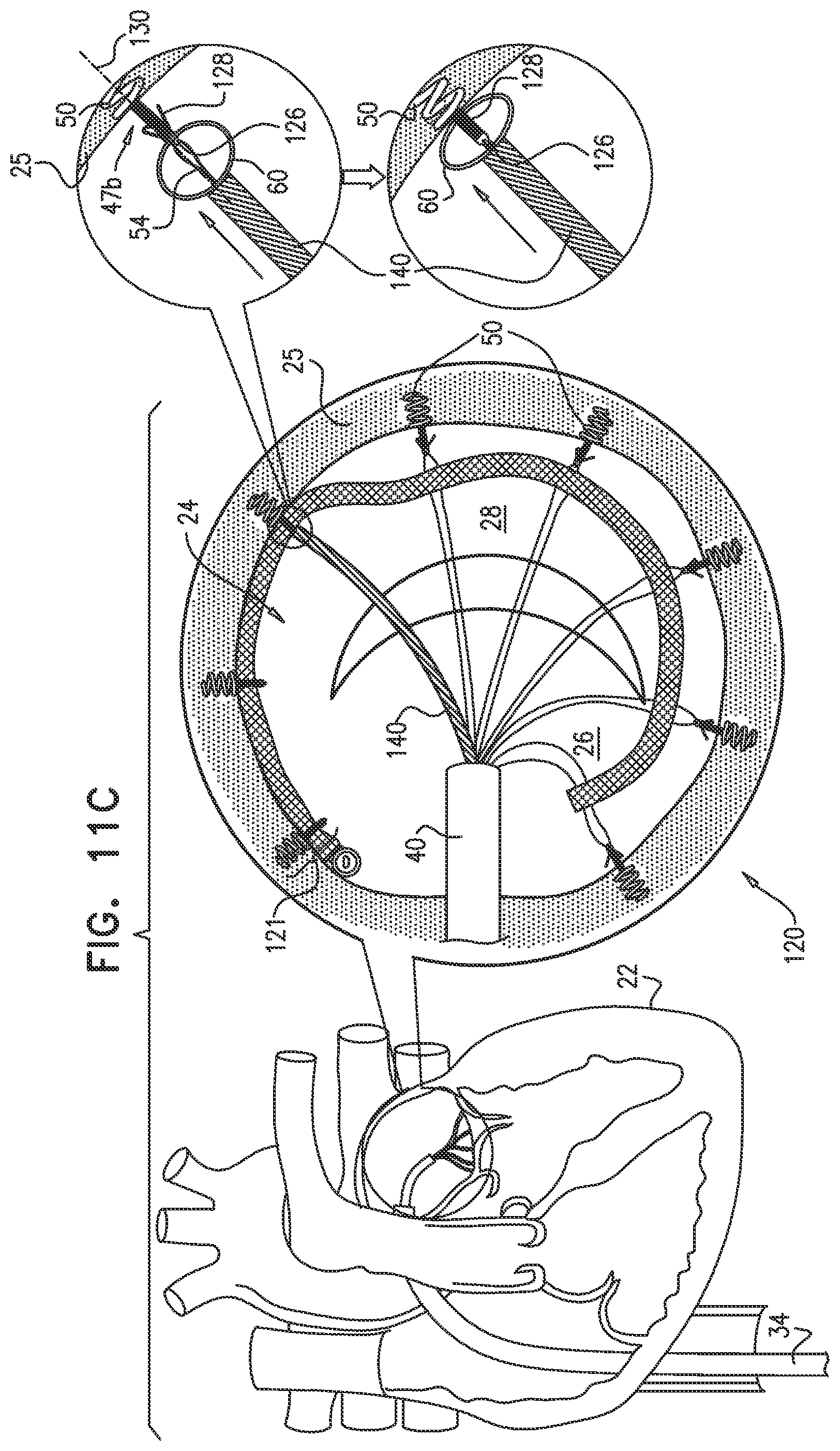Patent US12097118 Figure 13 – Tissue anchor for heart implant
