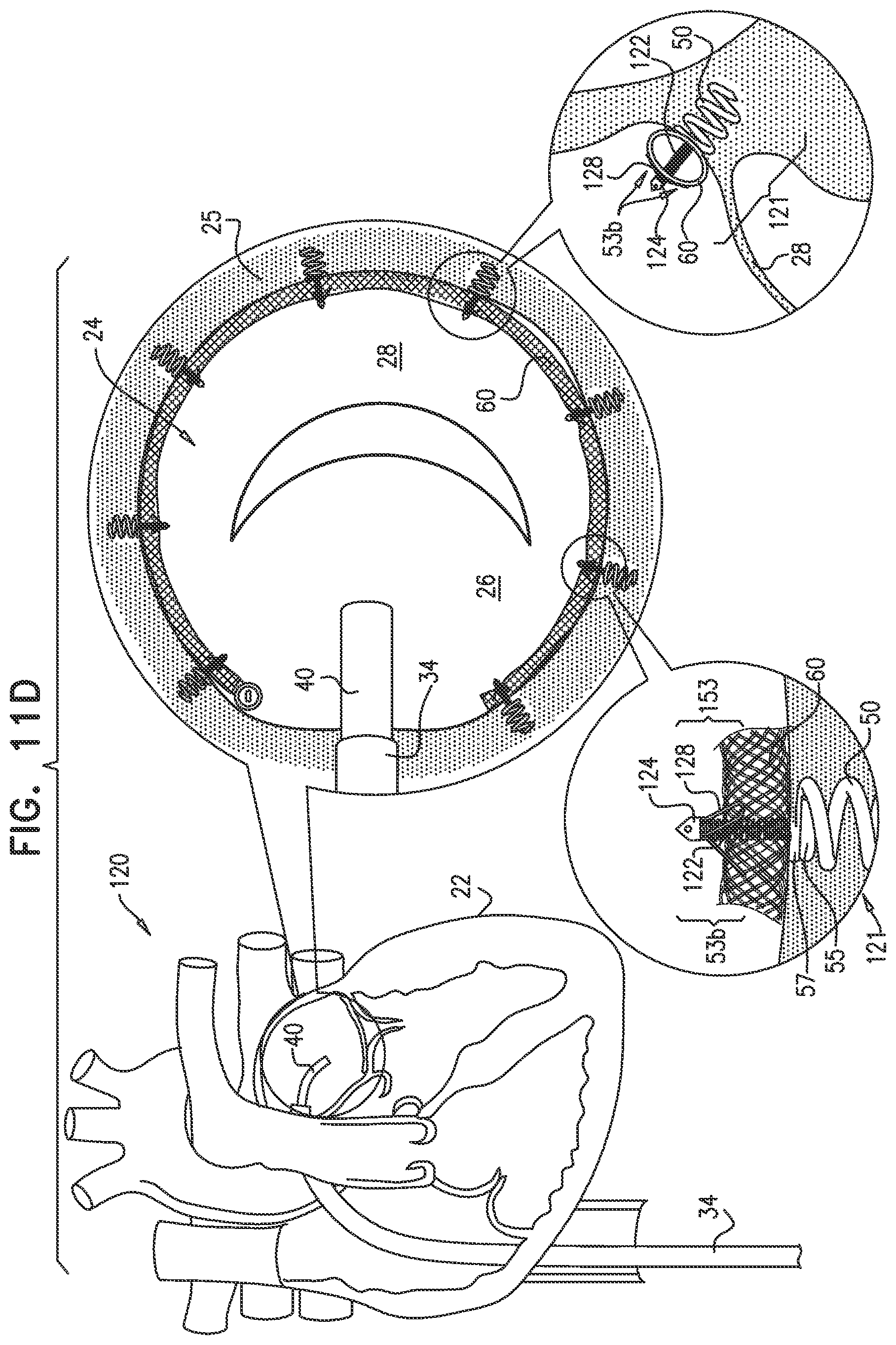 Patent US12097118 Figure 14 – Tissue anchor for heart implant