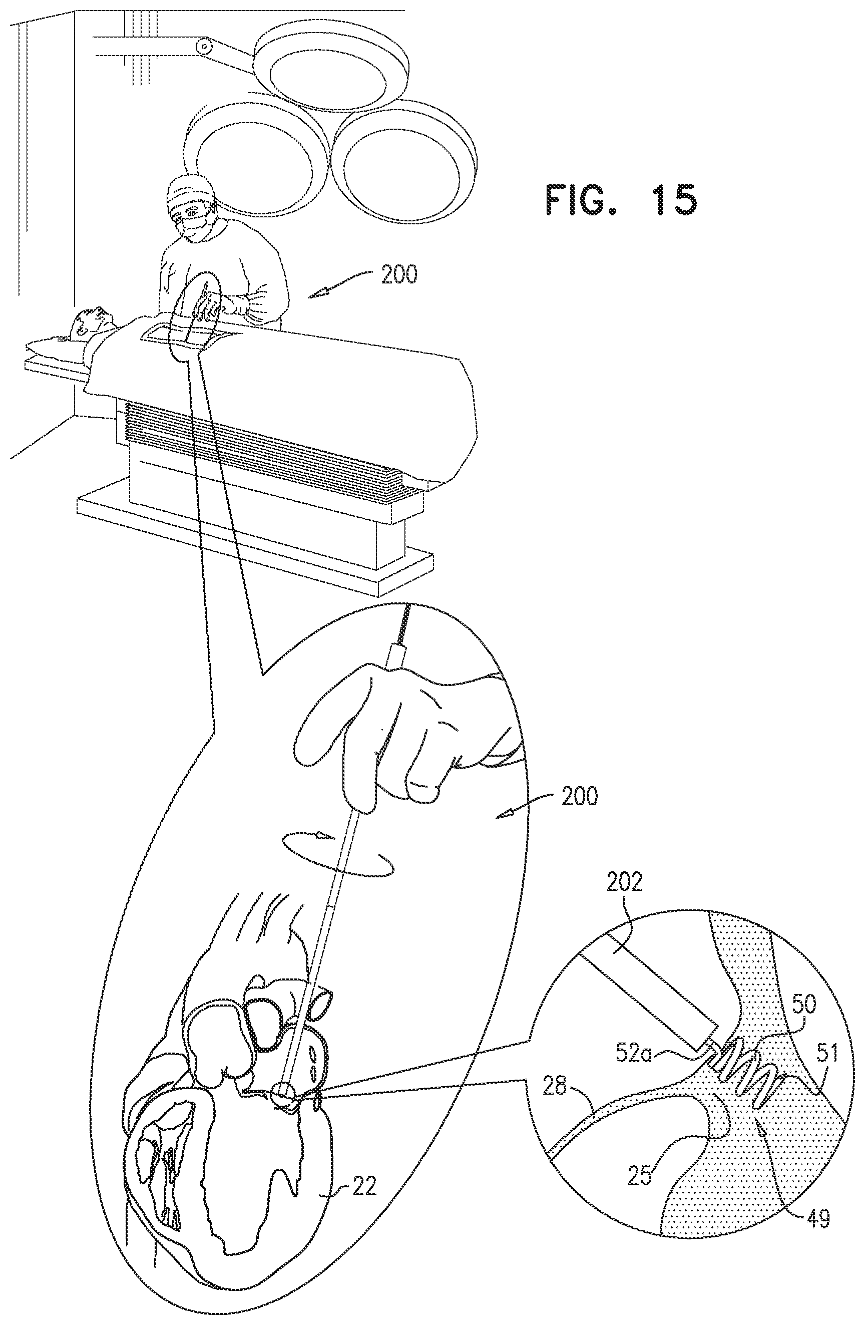 Patent US12097118 Figure 16 – Tissue anchor for heart implant