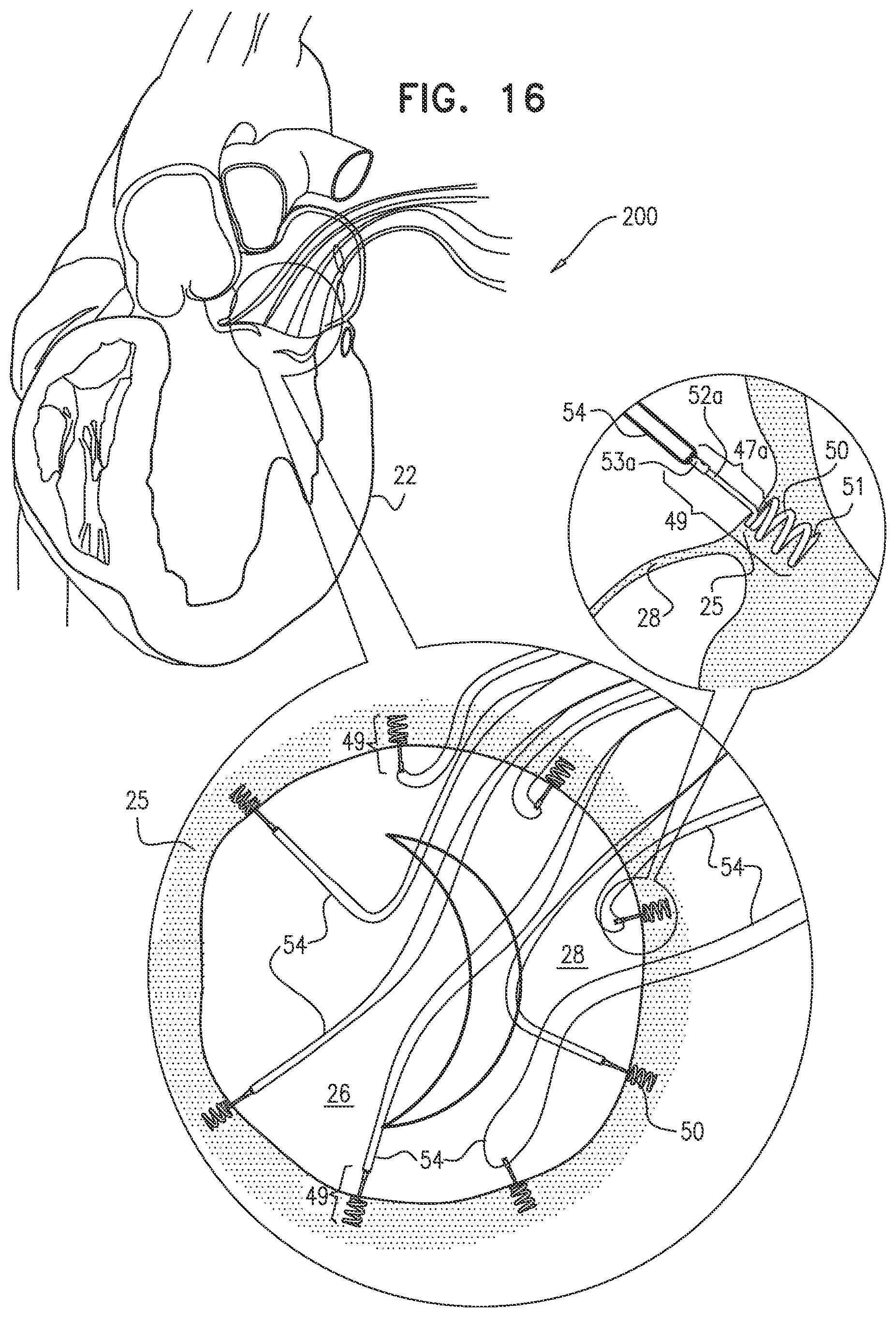 Patent US12097118 Figure 17 – Tissue anchor for heart implant