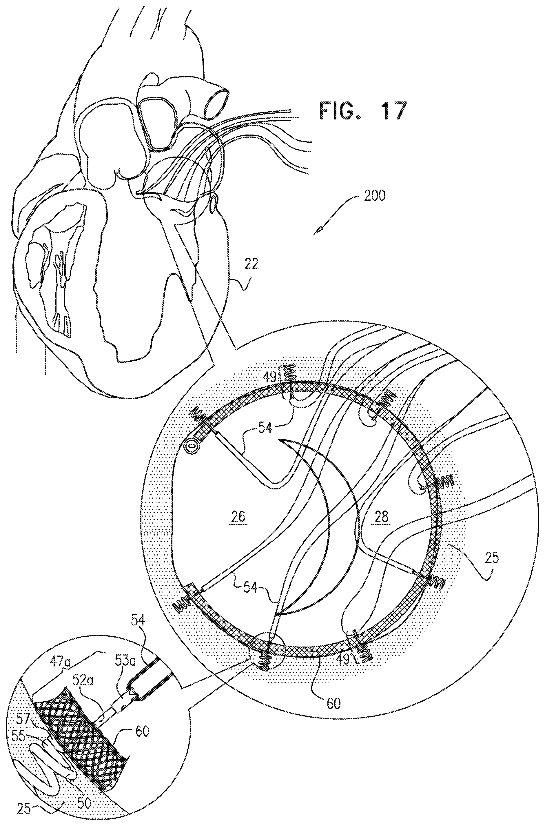 Patent US12097118 Figure 18 – Tissue anchor for heart implant