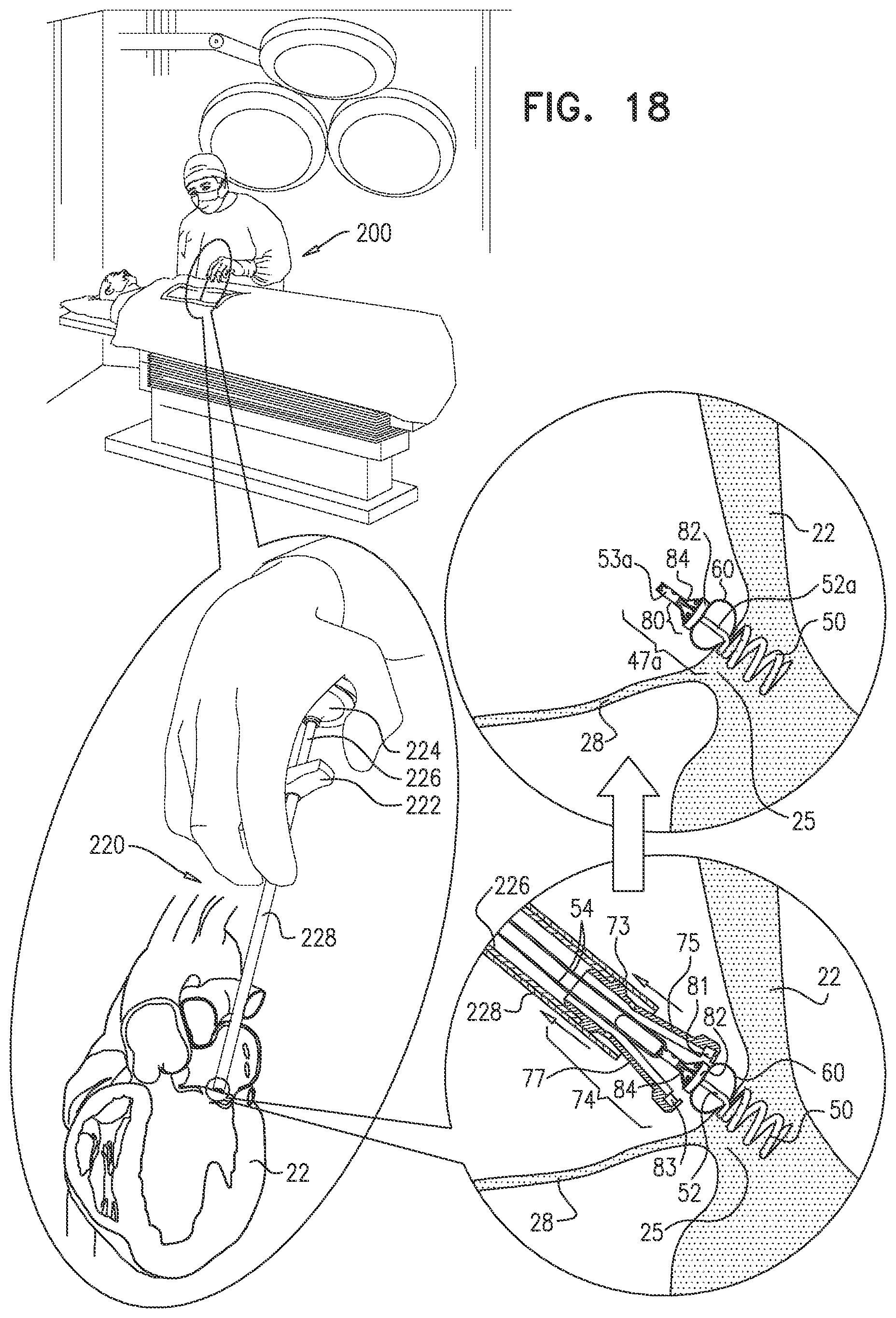 Patent US12097118 Figure 19 – Tissue anchor for heart implant