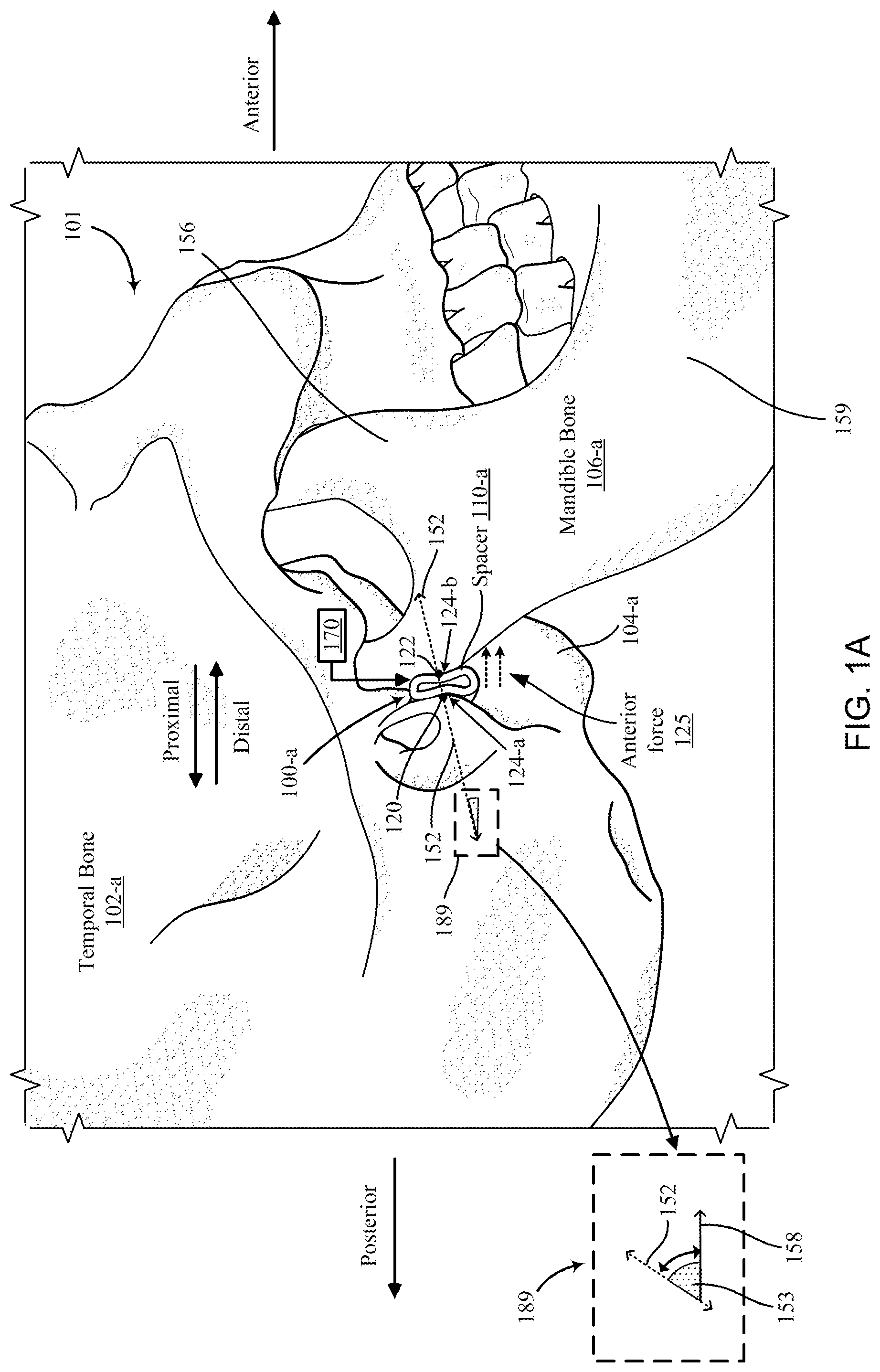 Patent US12097120 Figure 1 – Bone implant device