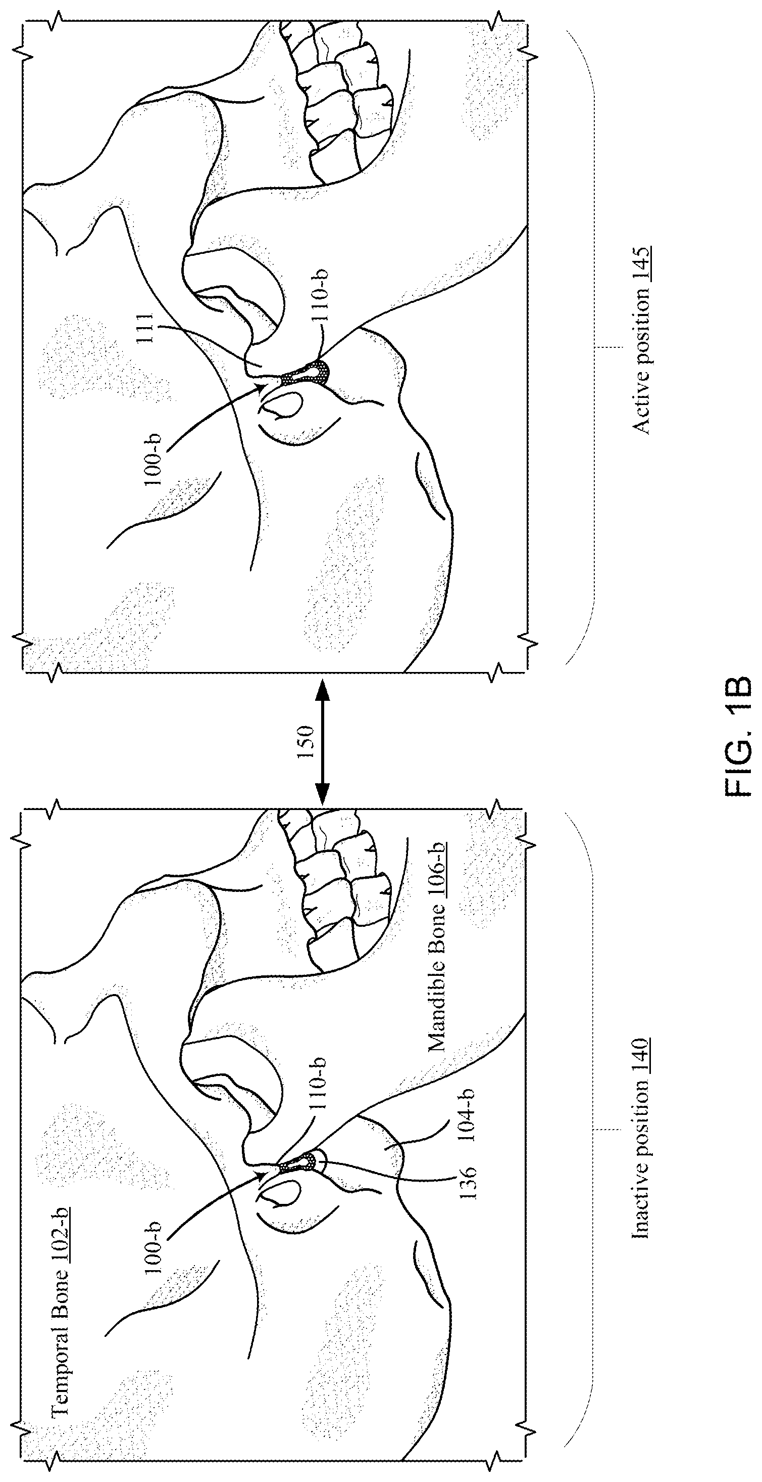 Patent US12097120 Figure 2 – Bone implant device