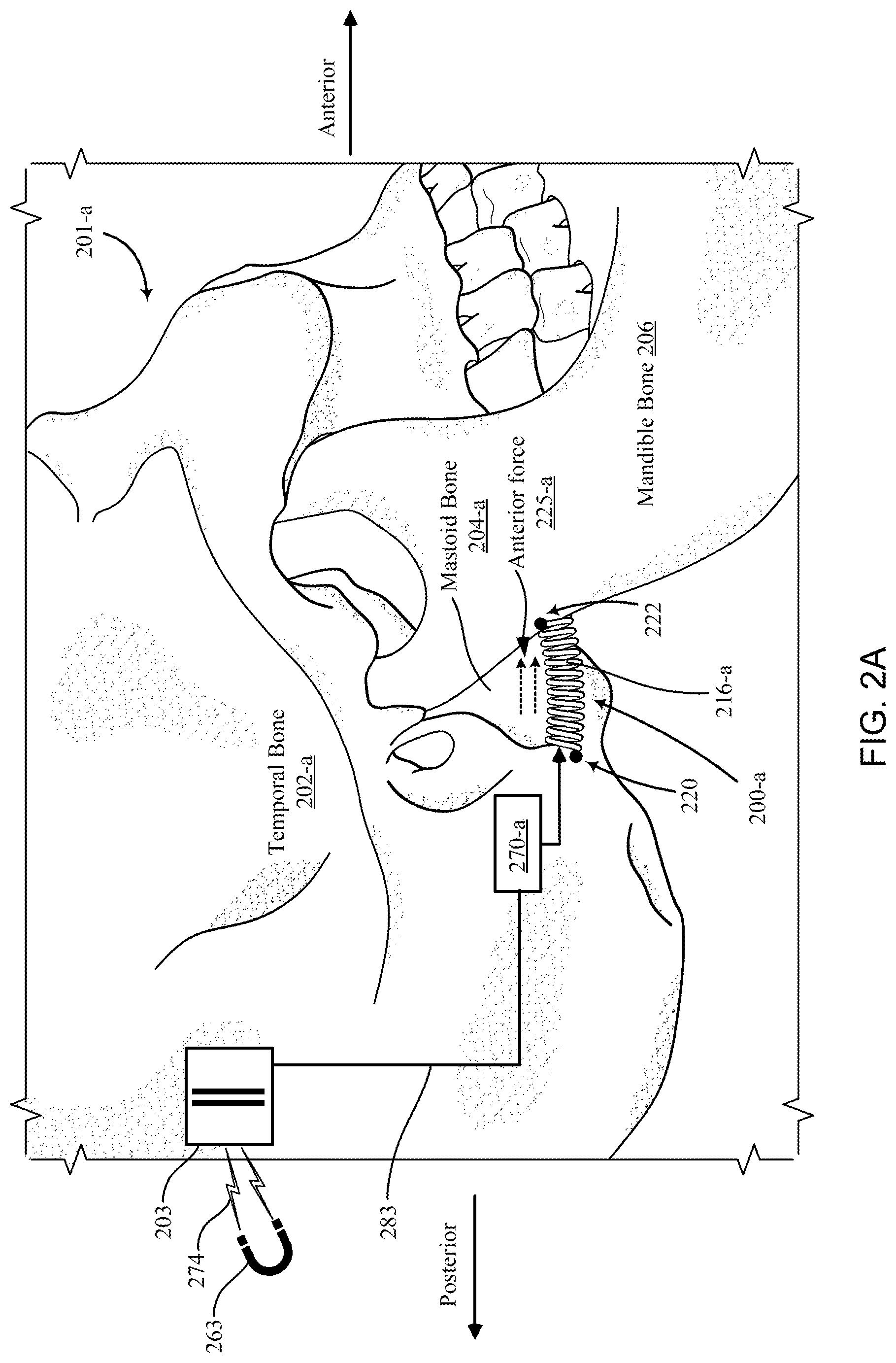 Patent US12097120 Figure 3 – Bone implant device