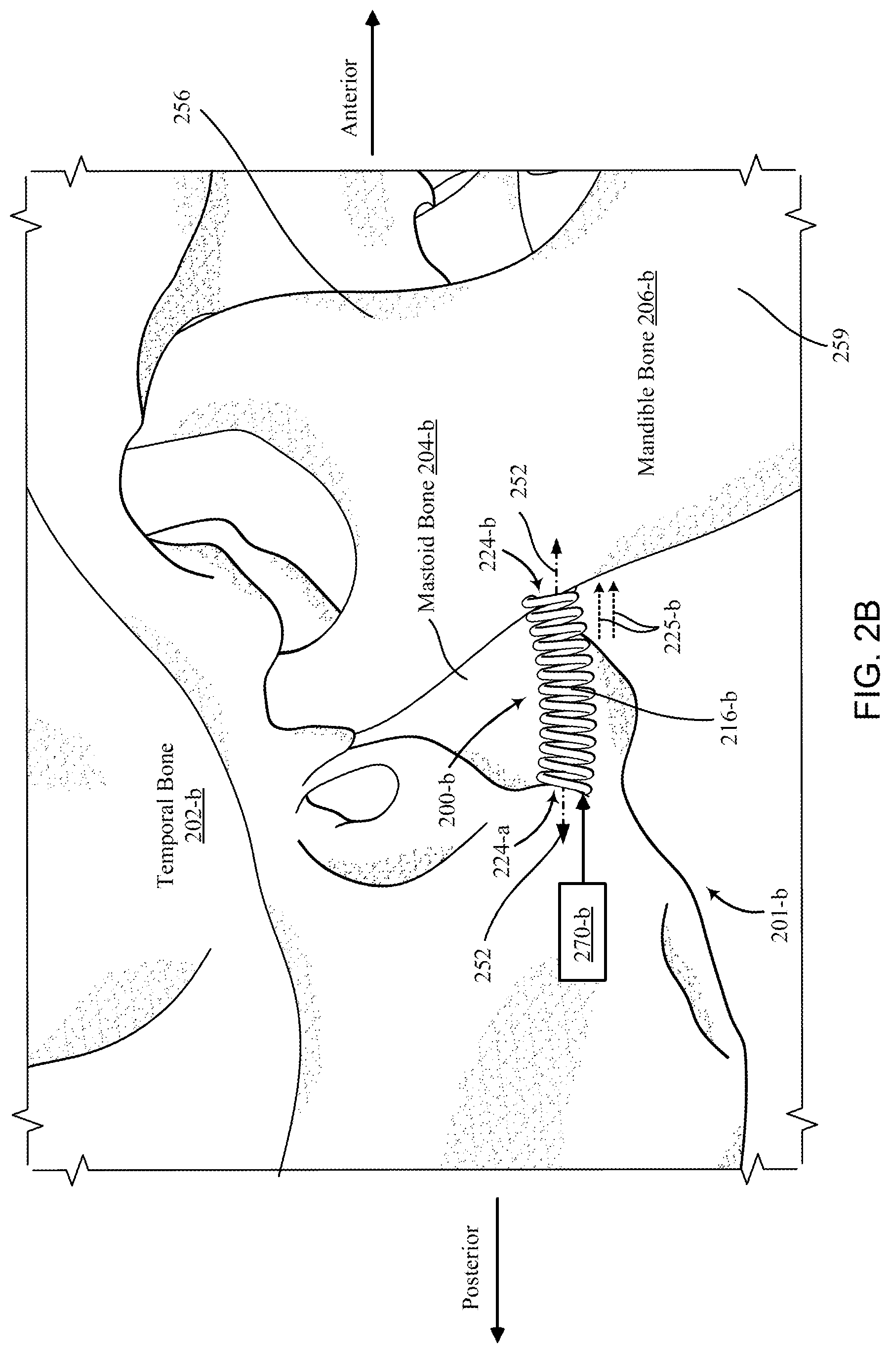 Patent US12097120 Figure 4 – Bone implant device