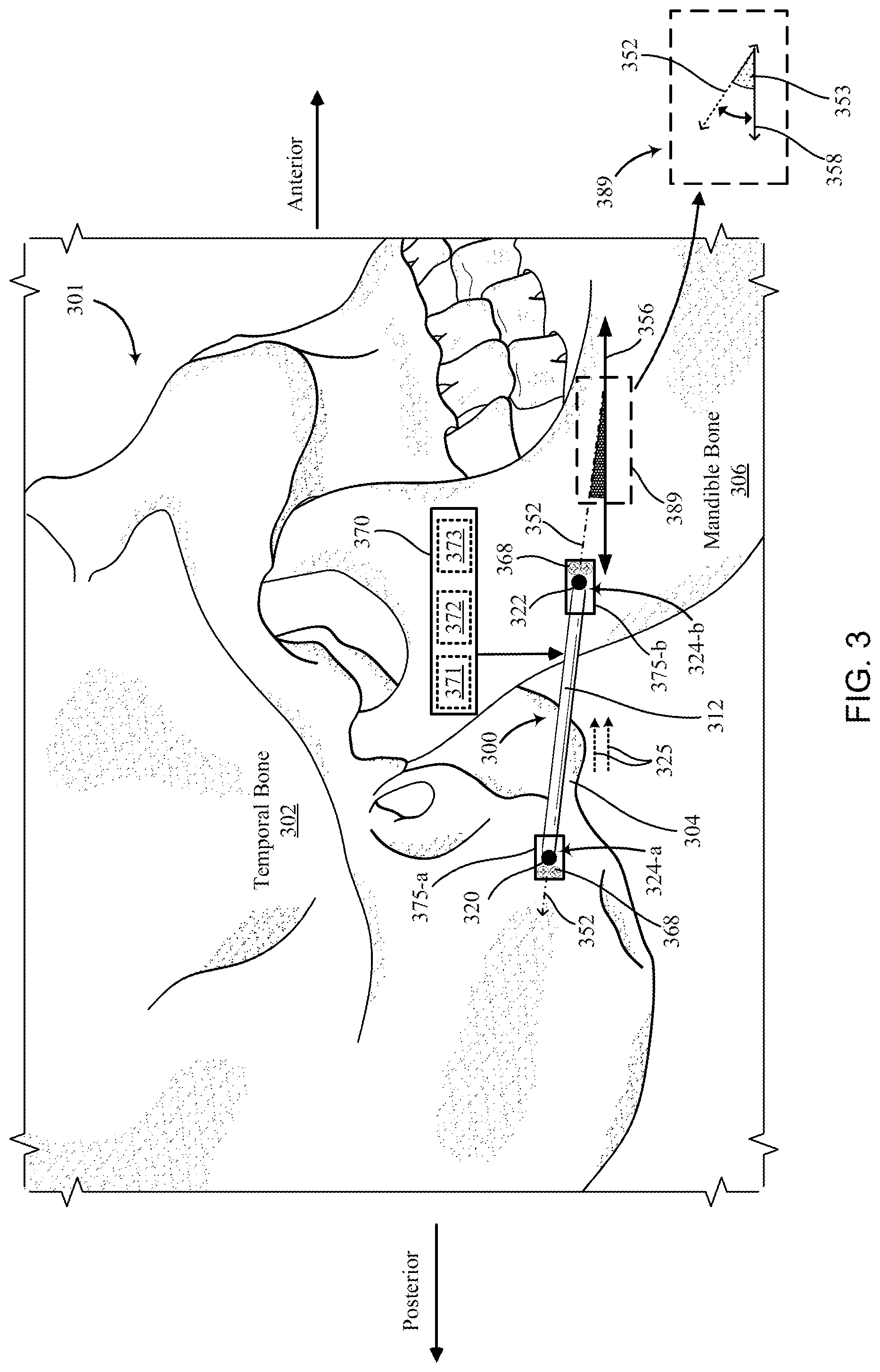 Patent US12097120 Figure 5 – Bone implant device