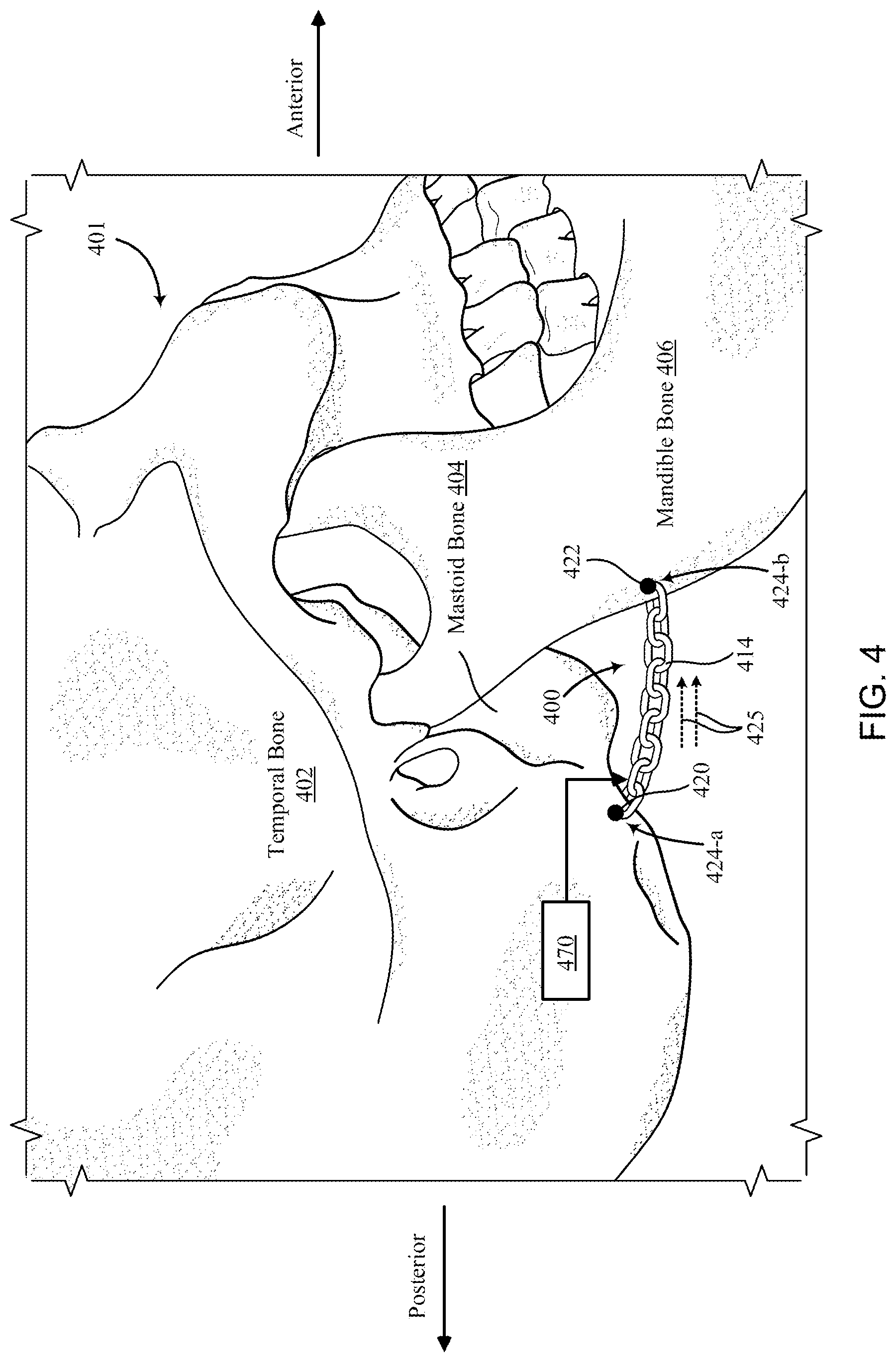 Patent US12097120 Figure 6 – Bone implant device