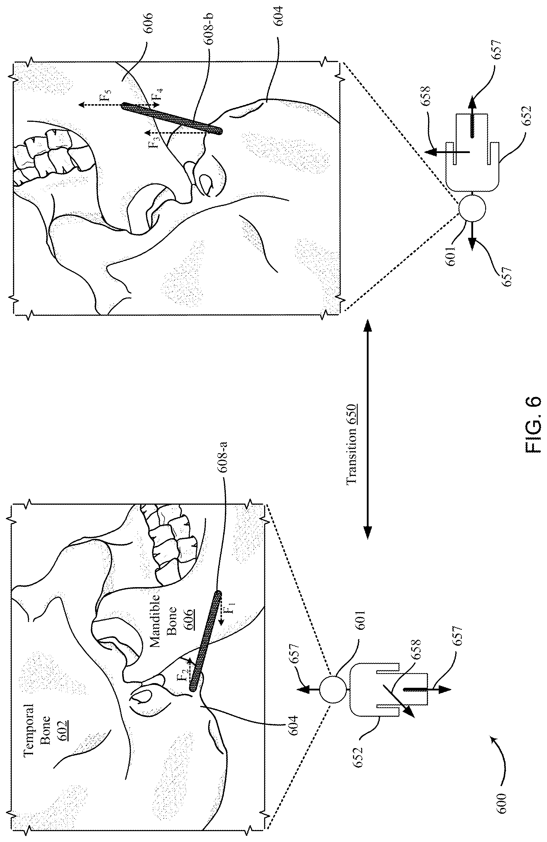 Patent US12097120 Figure 8 – Bone implant device