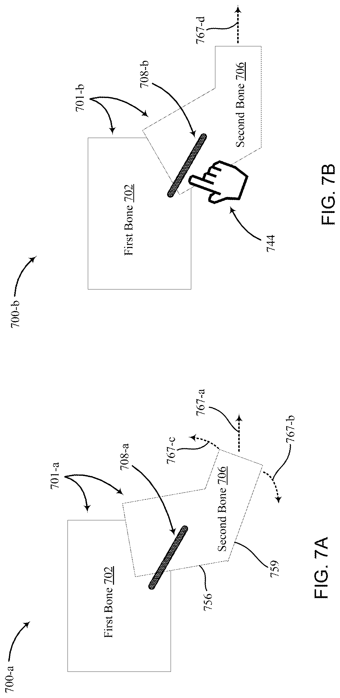 Patent US12097120 Figure 9 – Bone implant device