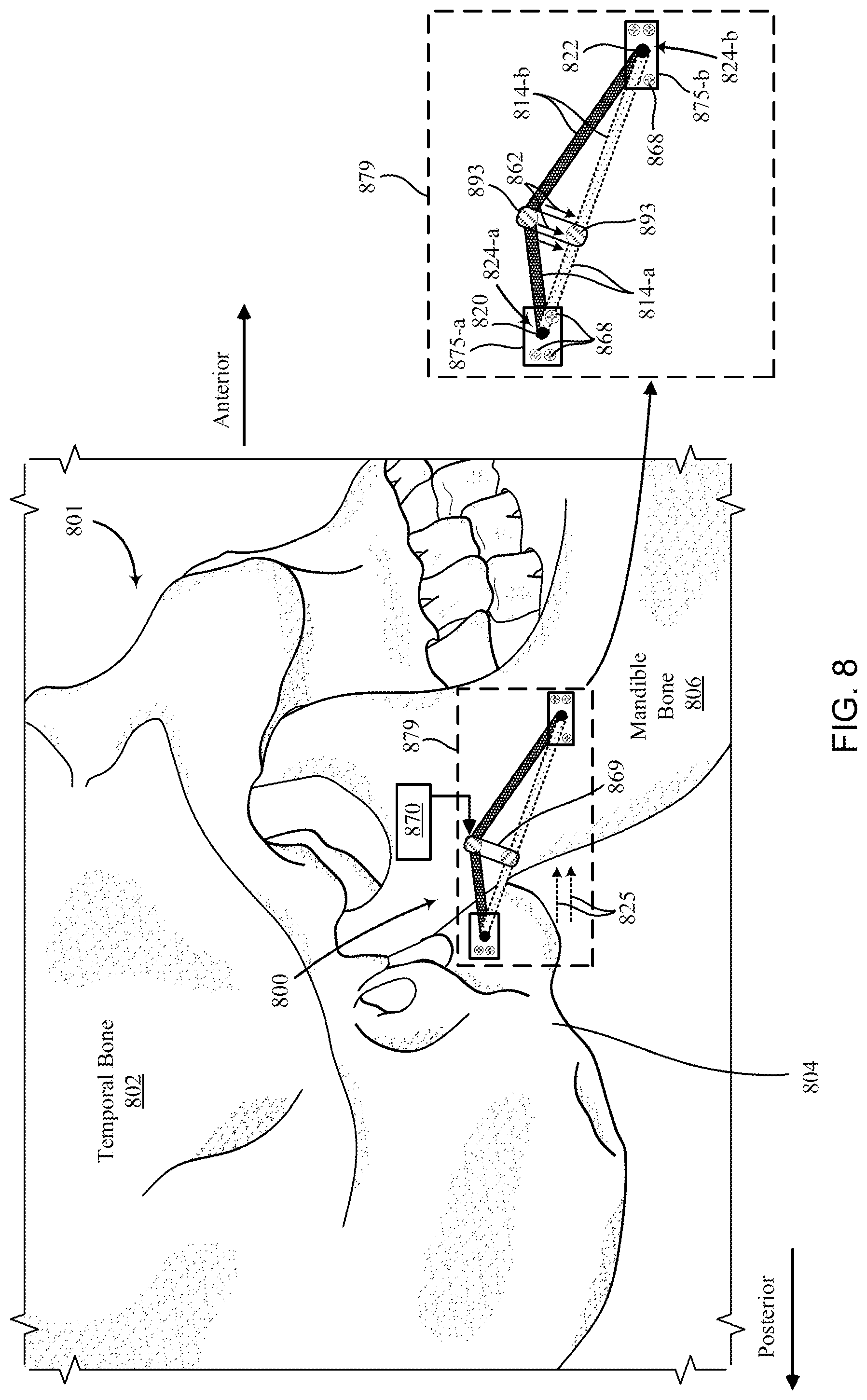 Patent US12097120 Figure 10 – Bone implant device
