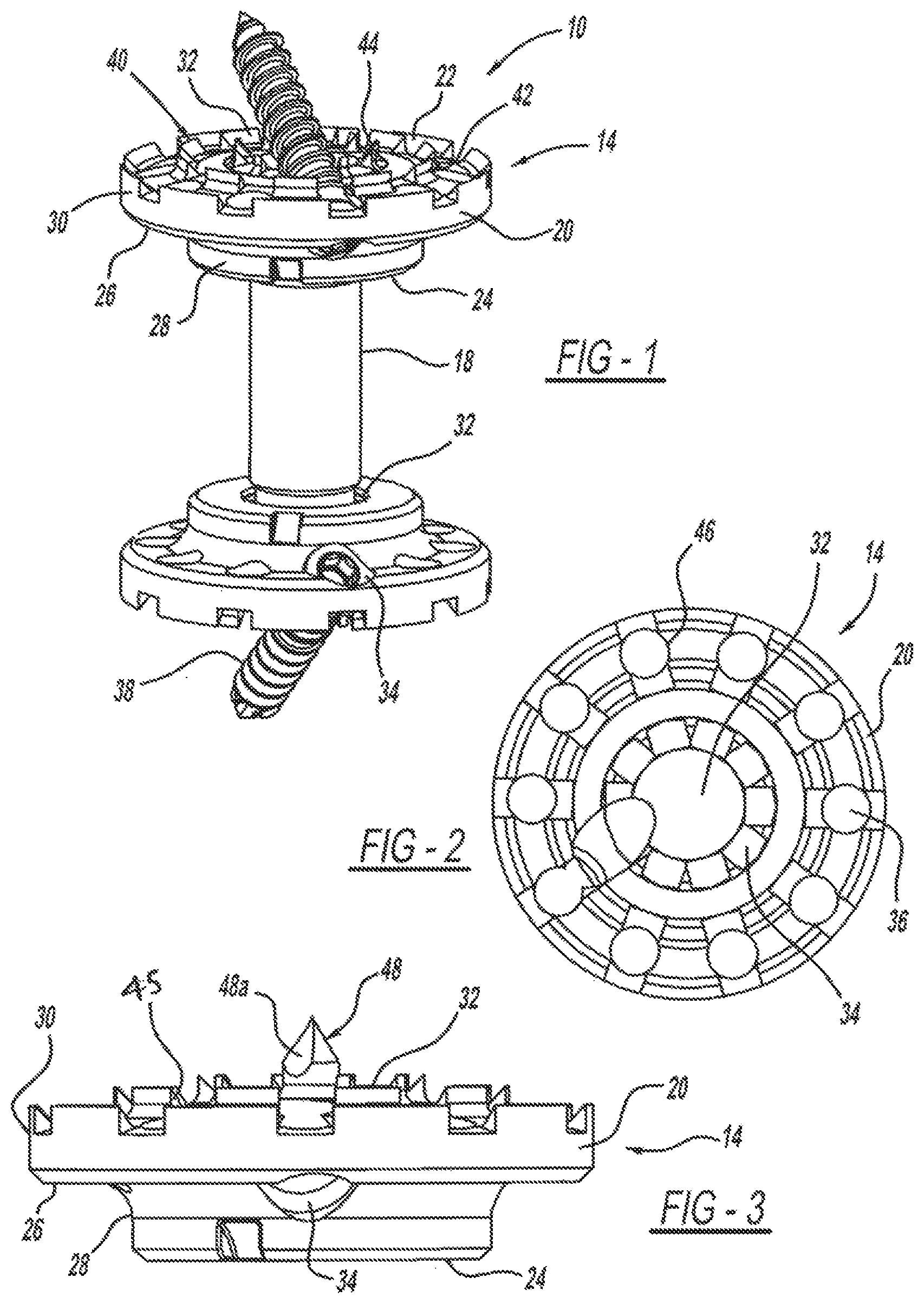 Patent US12097125 Figure 1 – Method and implant device for grafting adjacent vertebral bodies
