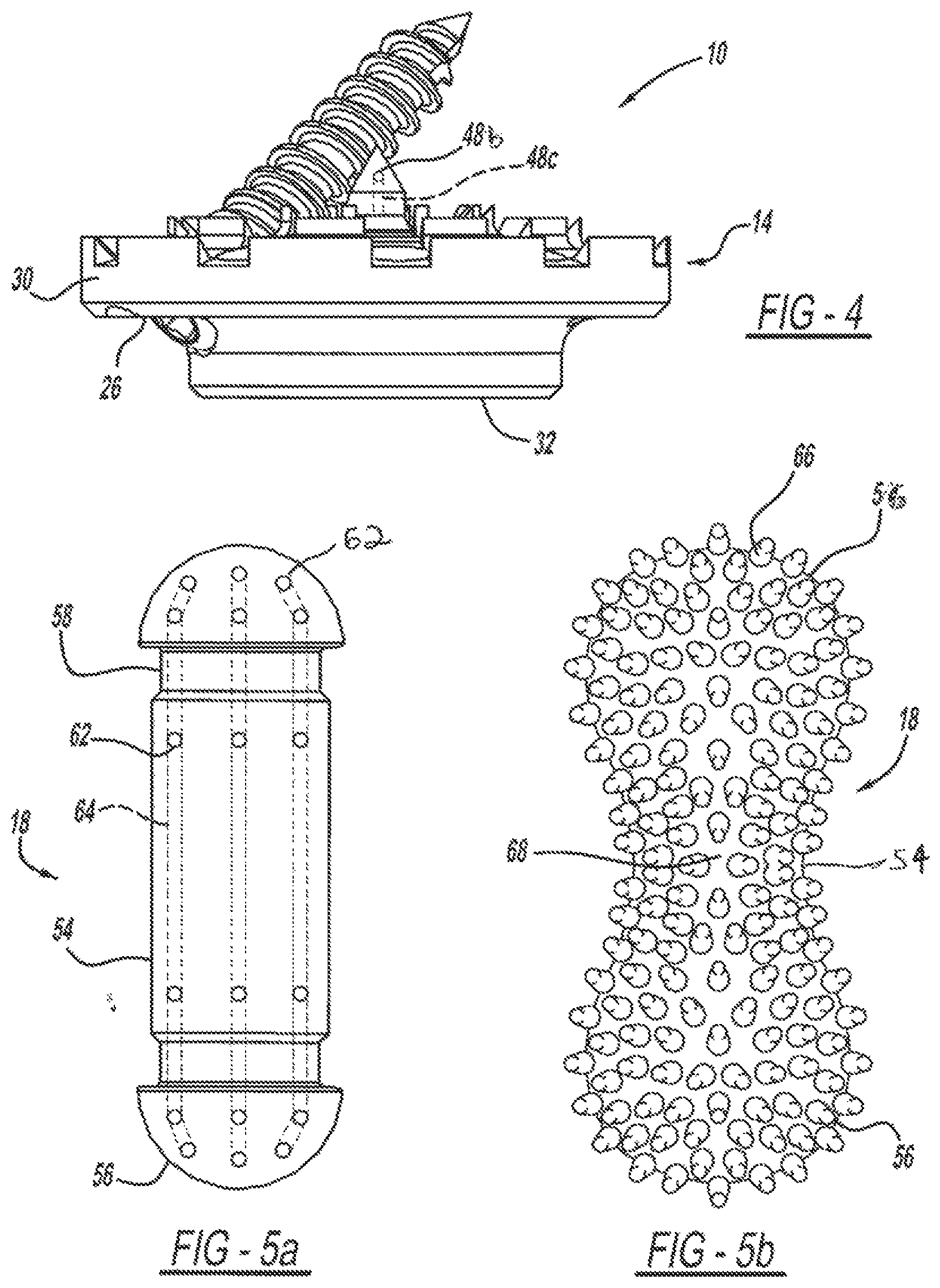 Patent US12097125 Figure 2 – Method and implant device for grafting adjacent vertebral bodies