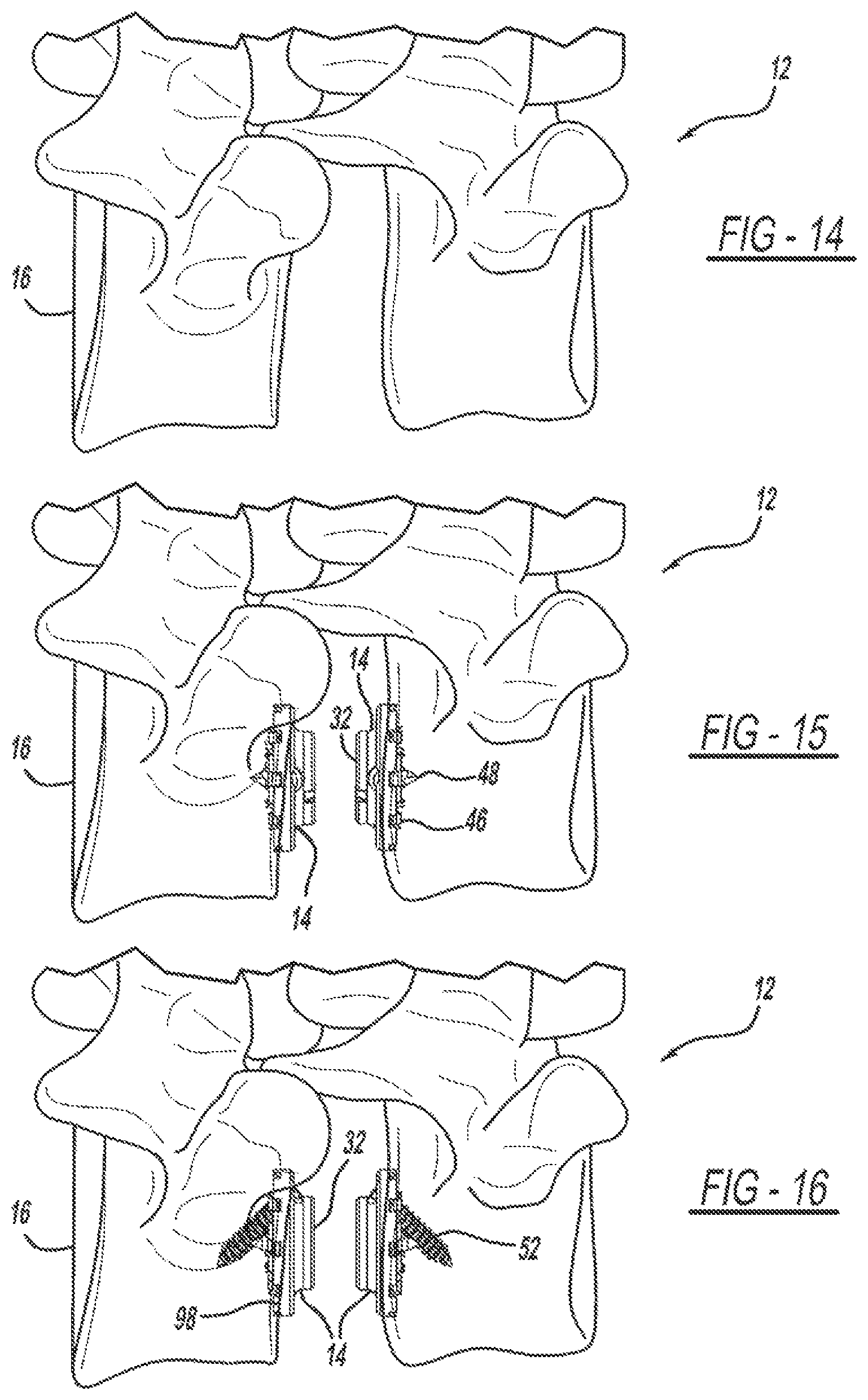 Patent US12097125 Figure 7 – Method and implant device for grafting adjacent vertebral bodies