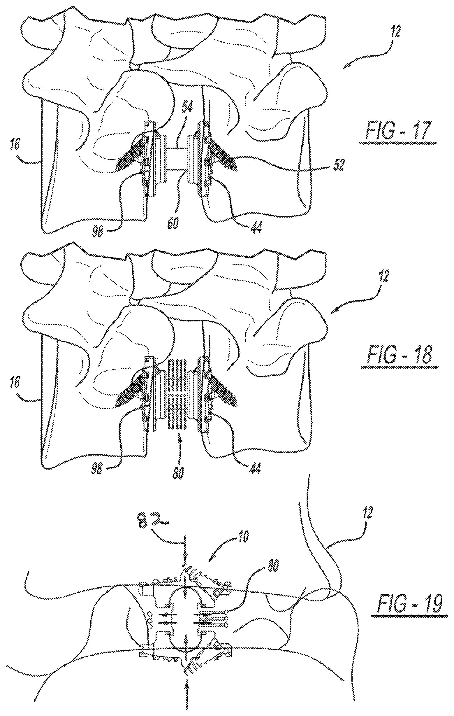 Patent US12097125 Figure 8 – Method and implant device for grafting adjacent vertebral bodies