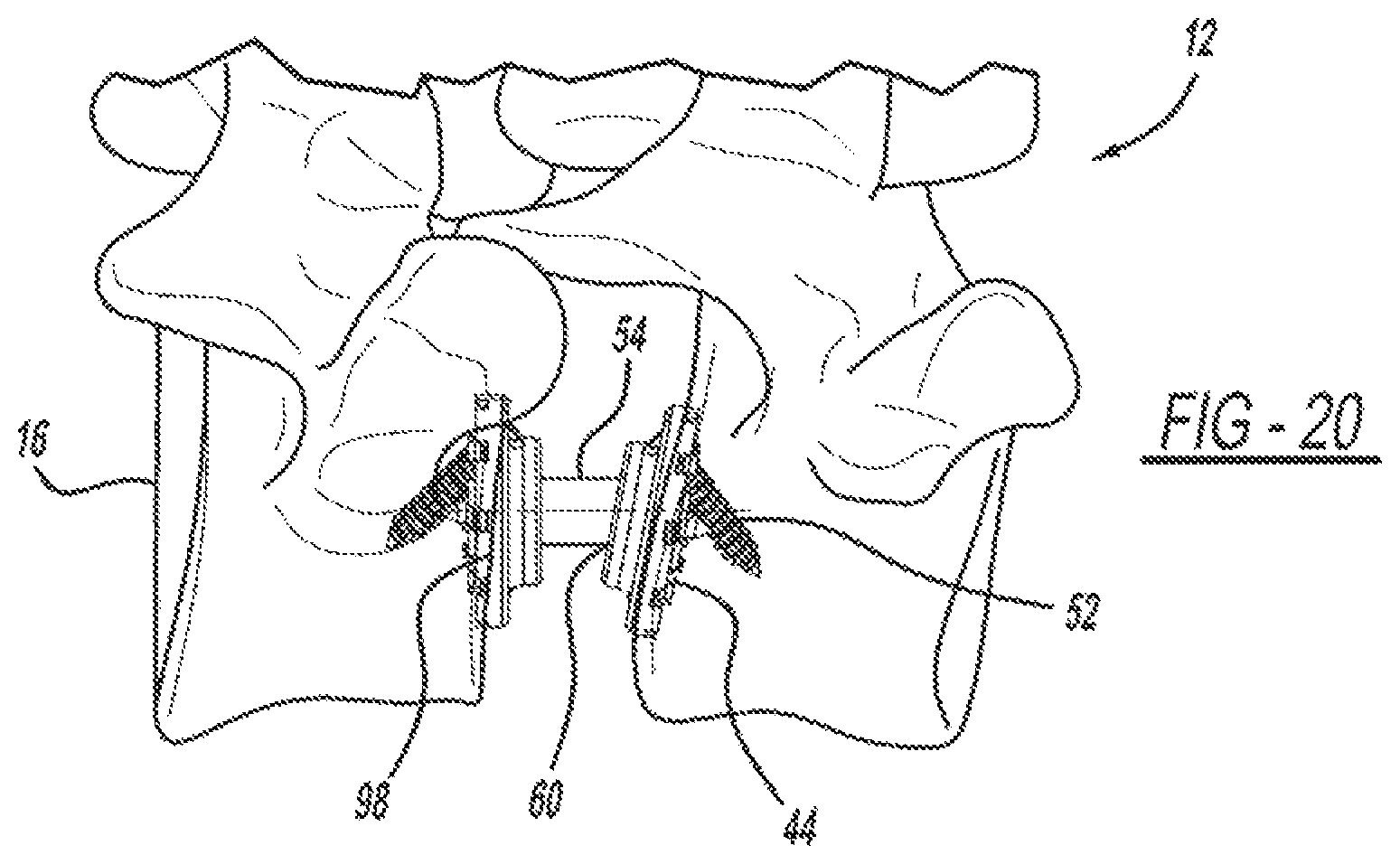 Patent US12097125 Figure 9 – Method and implant device for grafting adjacent vertebral bodies