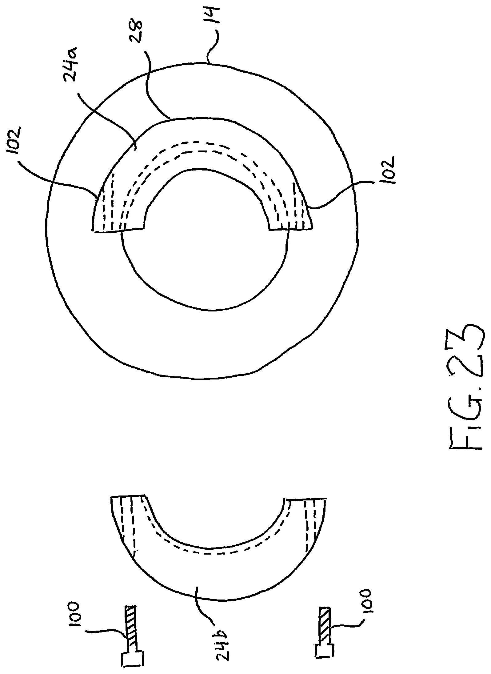 Patent US12097125 Figure 12 – Method and implant device for grafting adjacent vertebral bodies