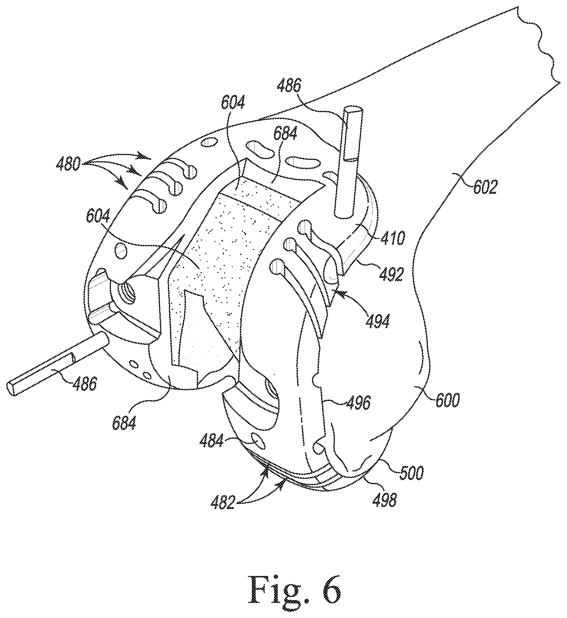 Patent US12097128 Figure 6 – System and method for preparing a patient's femur in an orthopaedic joint replacement procedure