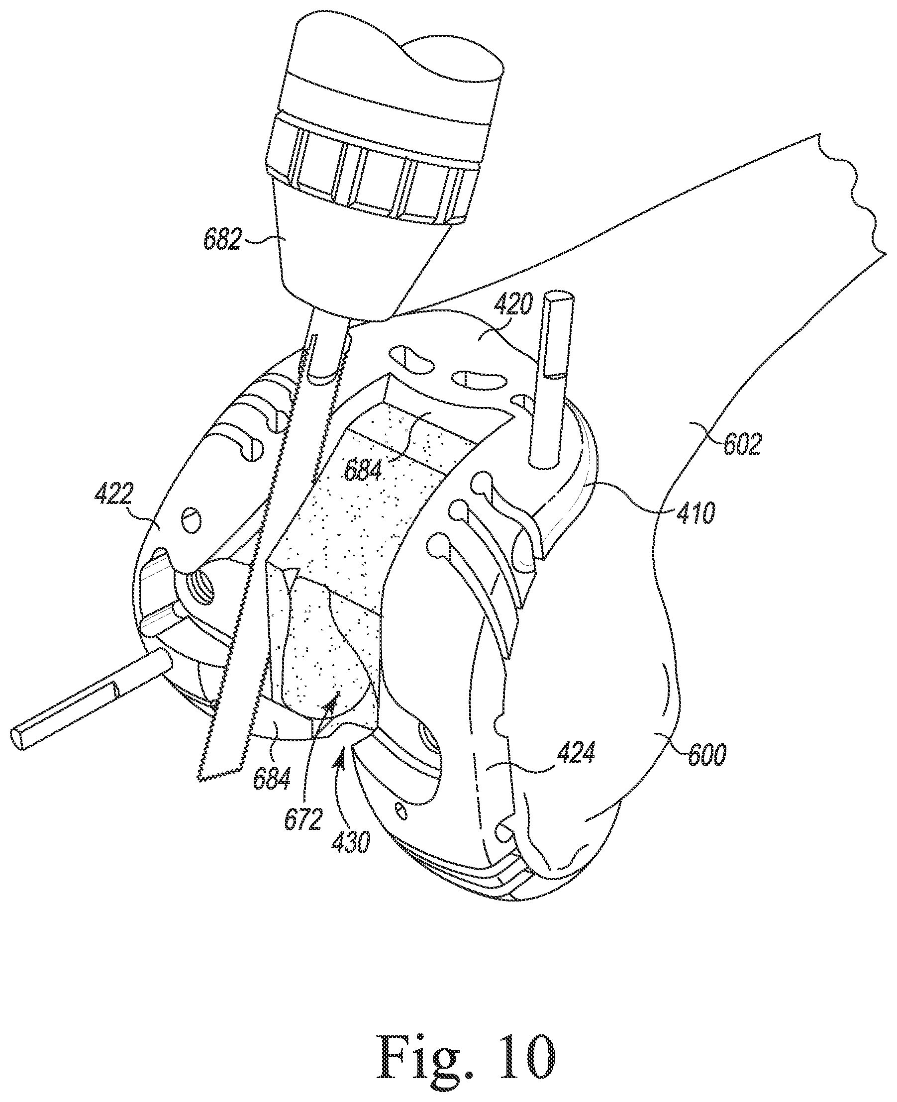 Patent US12097128 Figure 11 – System and method for preparing a patient's femur in an orthopaedic joint replacement procedure