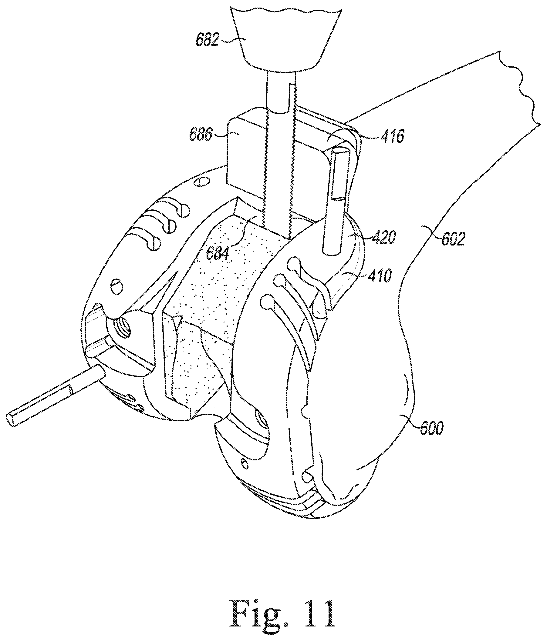 Patent US12097128 Figure 12 – System and method for preparing a patient's femur in an orthopaedic joint replacement procedure