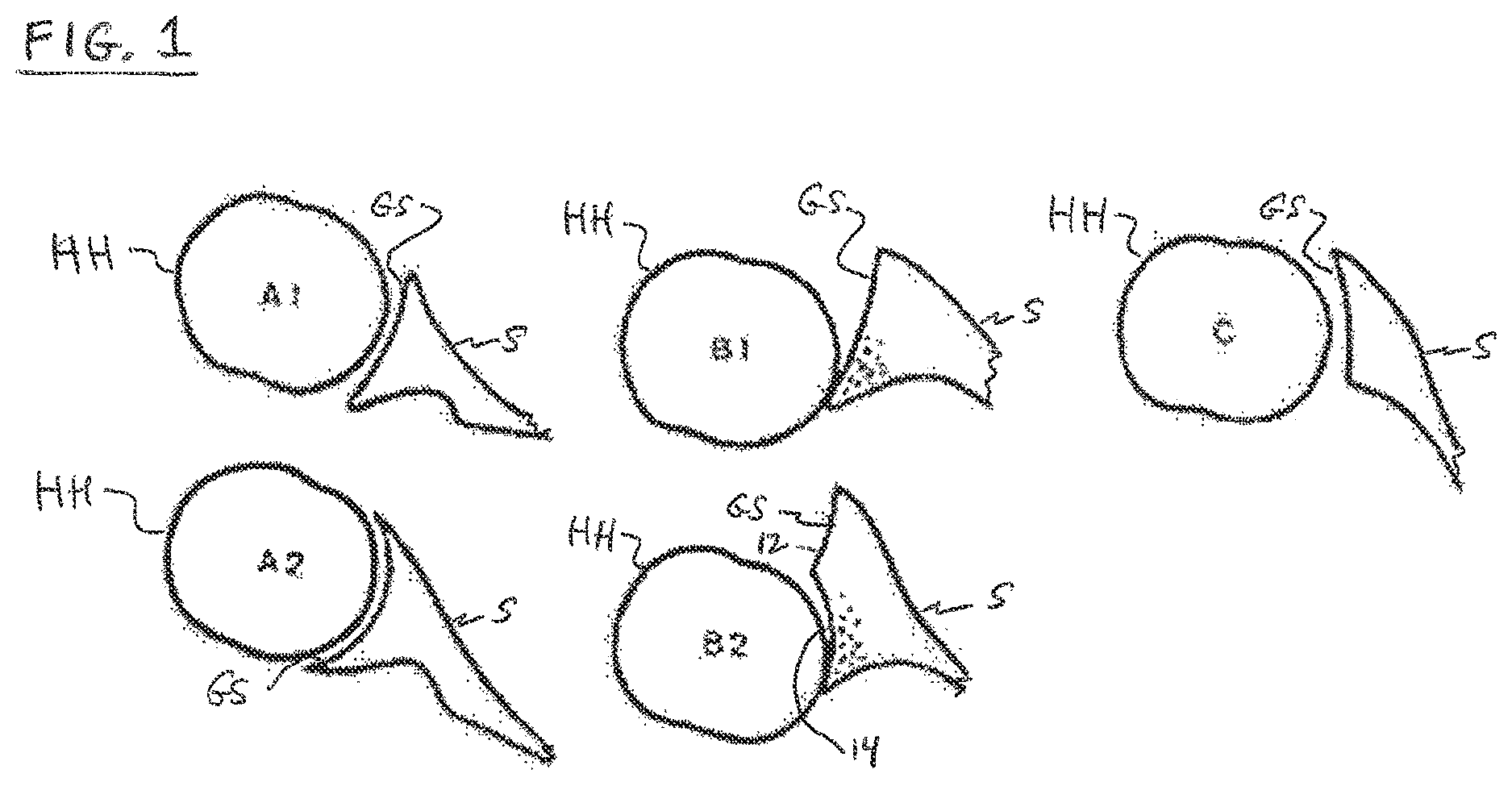 Patent US12097129 Figure 1 – Shoulder patient specific instrument