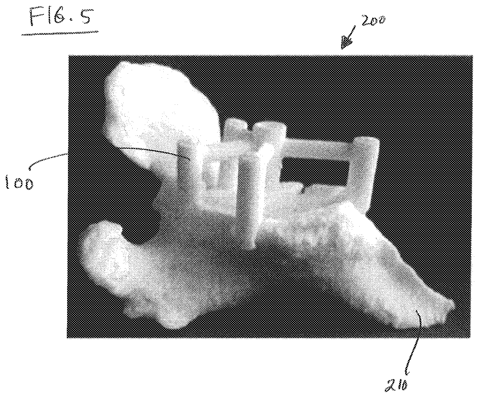 Patent US12097129 Figure 4 – Shoulder patient specific instrument