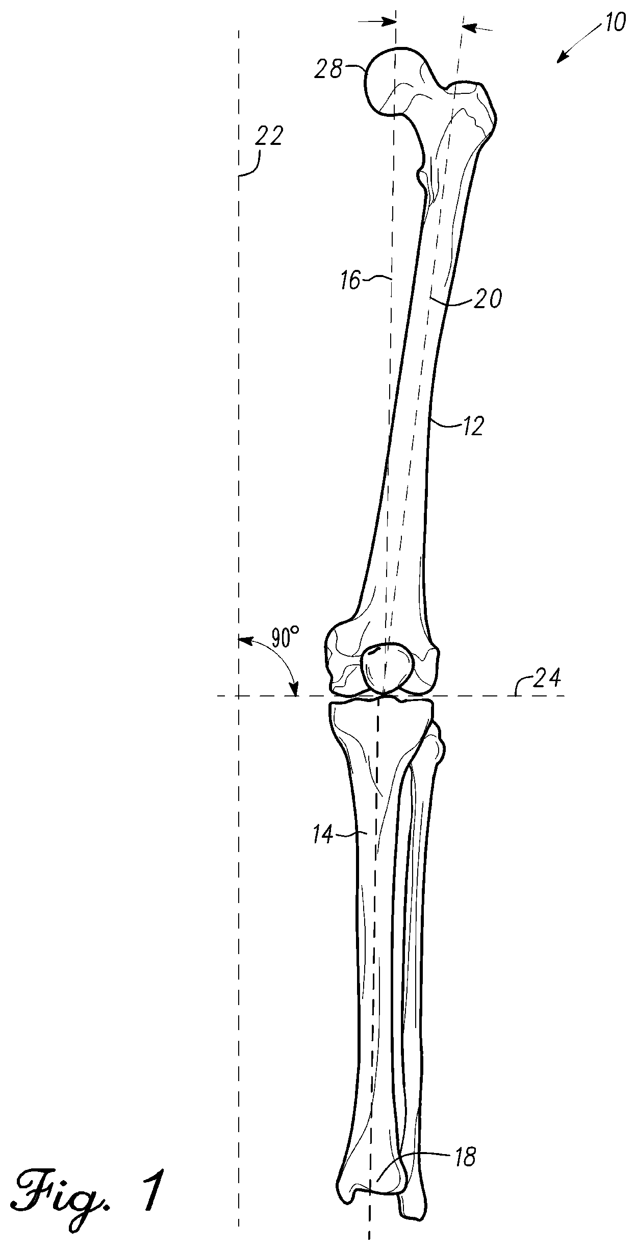 Patent US12097130 Figure 1 – Orthopedic leg alignment system and method