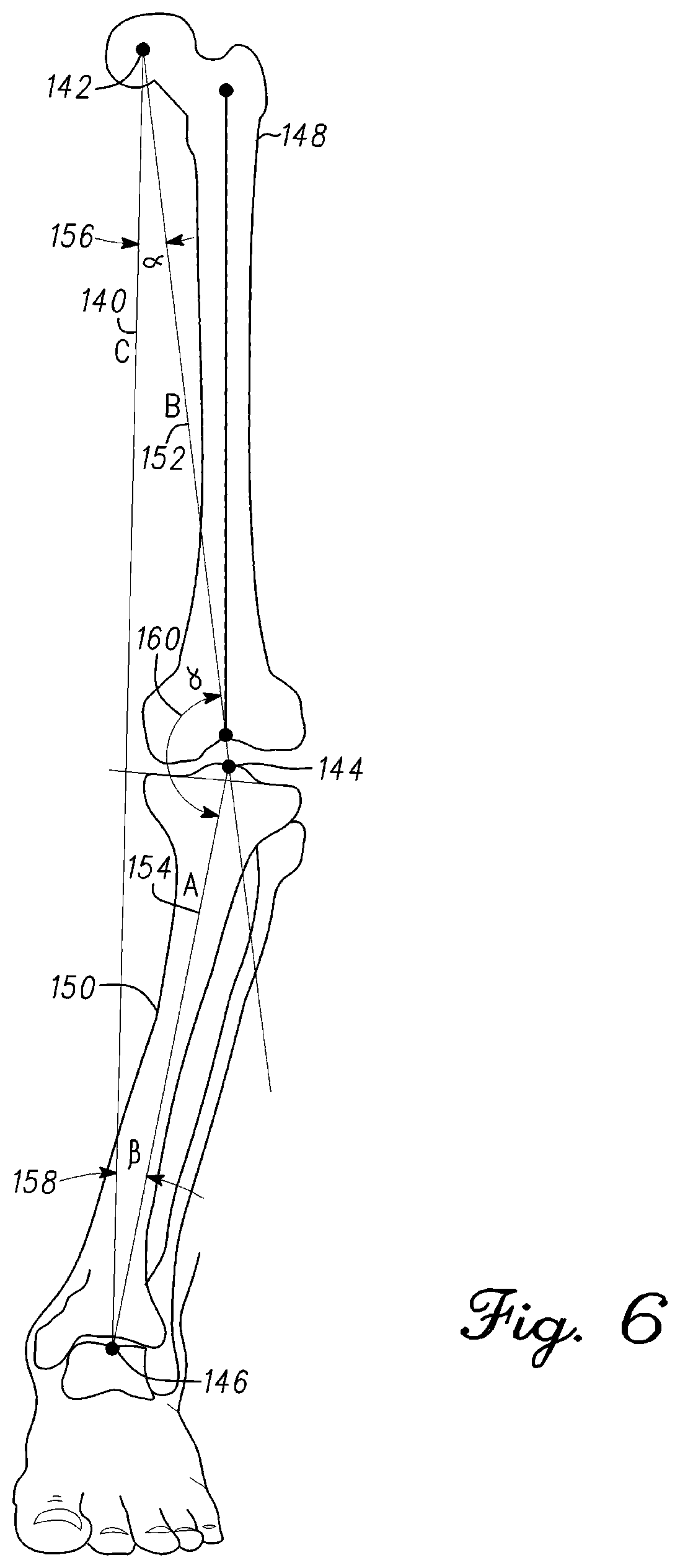 Patent US12097130 Figure 5 – Orthopedic leg alignment system and method