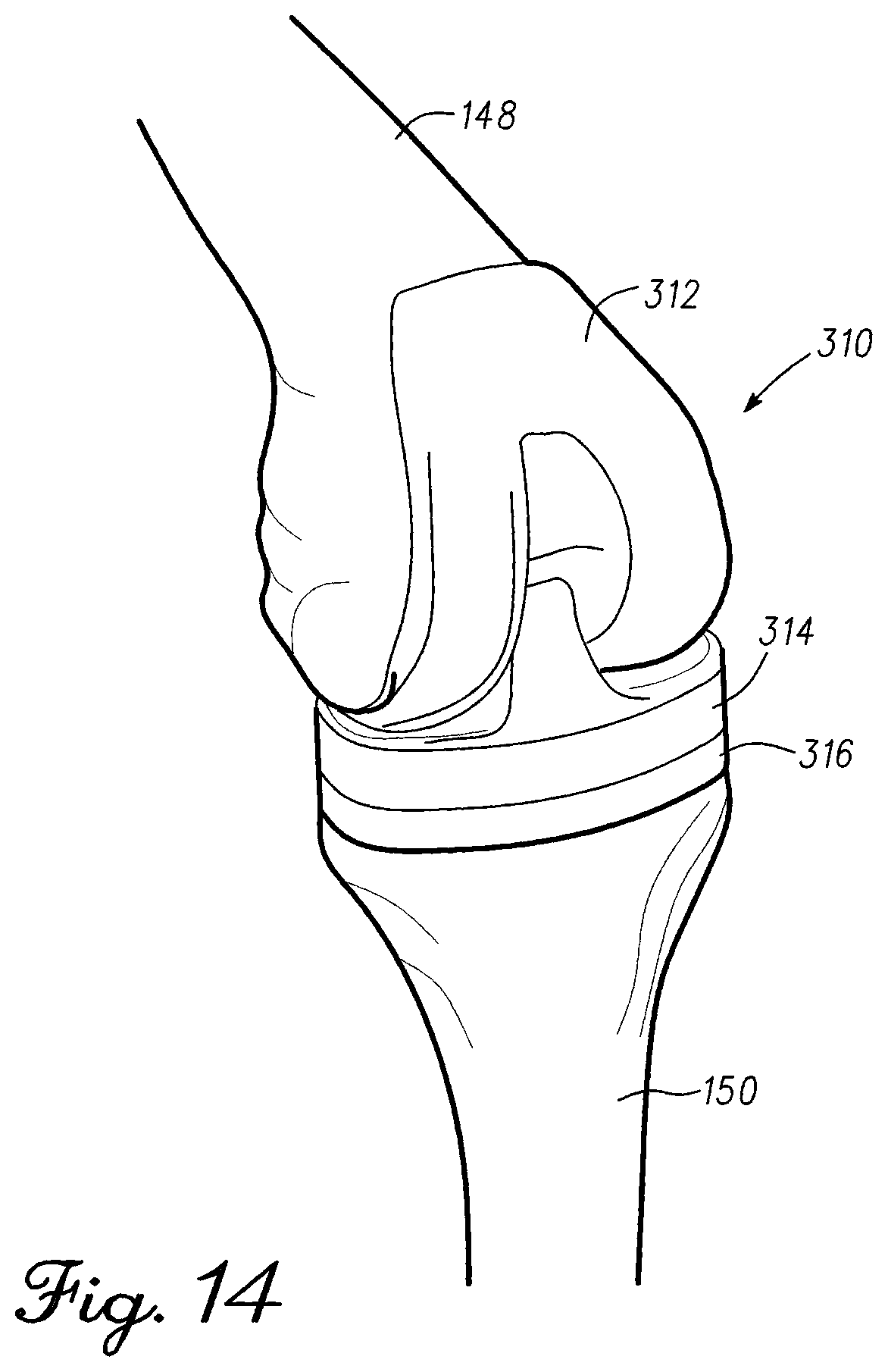 Patent US12097130 Figure 10 – Orthopedic leg alignment system and method