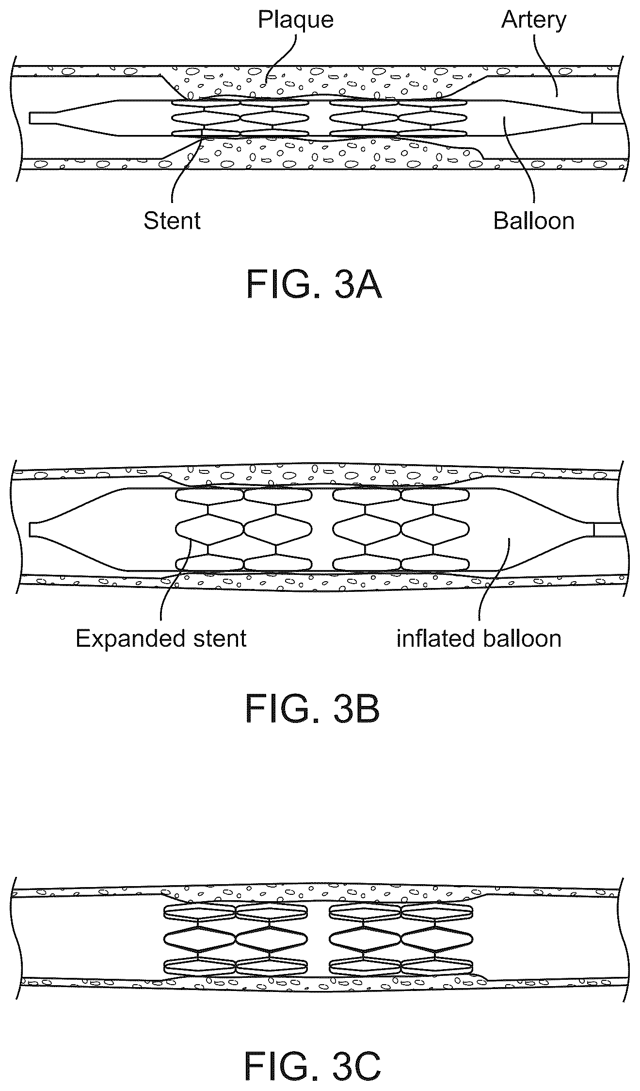 Patent US12097134 Figure 3 – Absorbable intravascular devices that provide a decrease in radial rigidity of the vessel over time