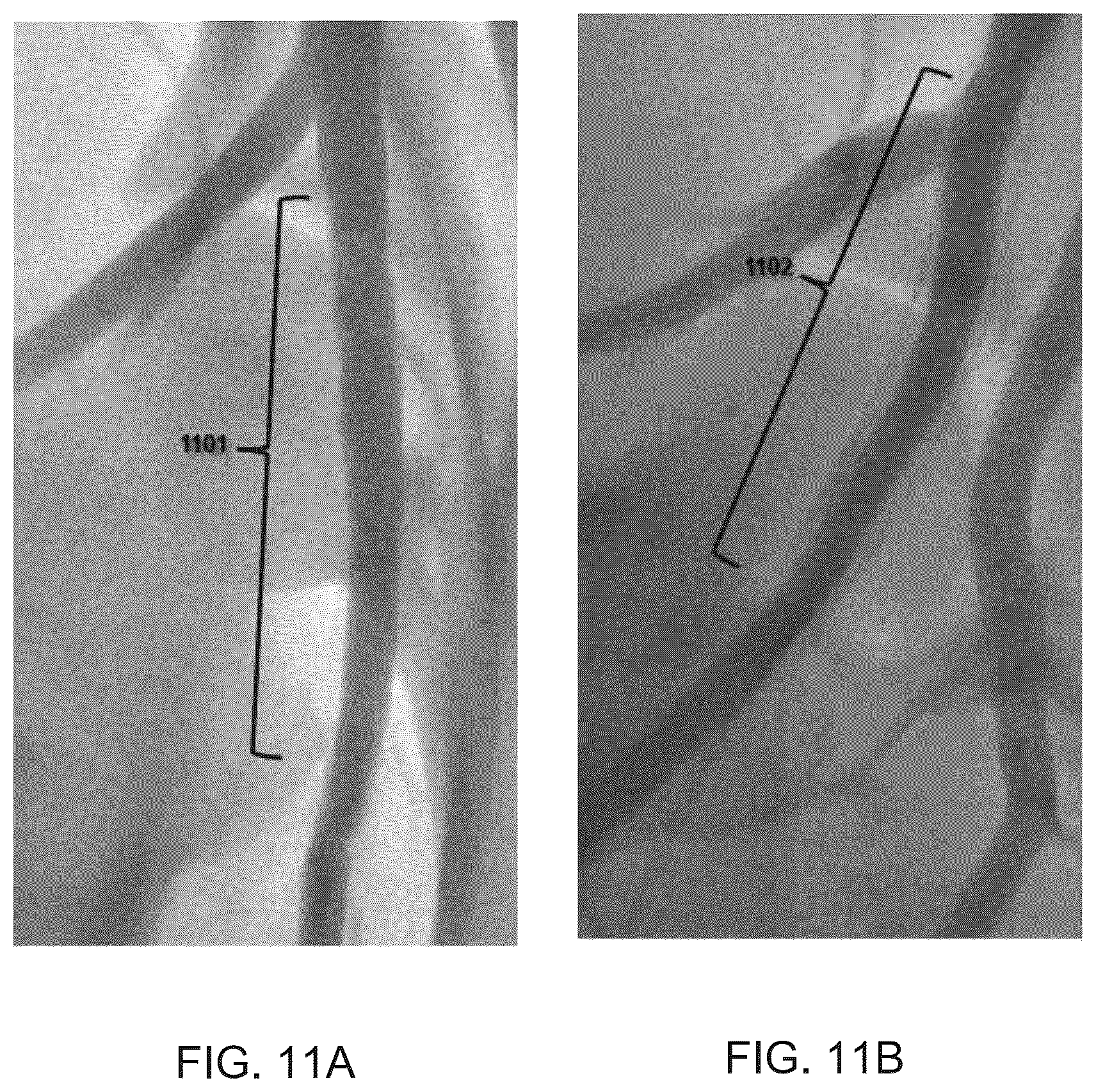 Patent US12097134 Figure 20 – Absorbable intravascular devices that provide a decrease in radial rigidity of the vessel over time