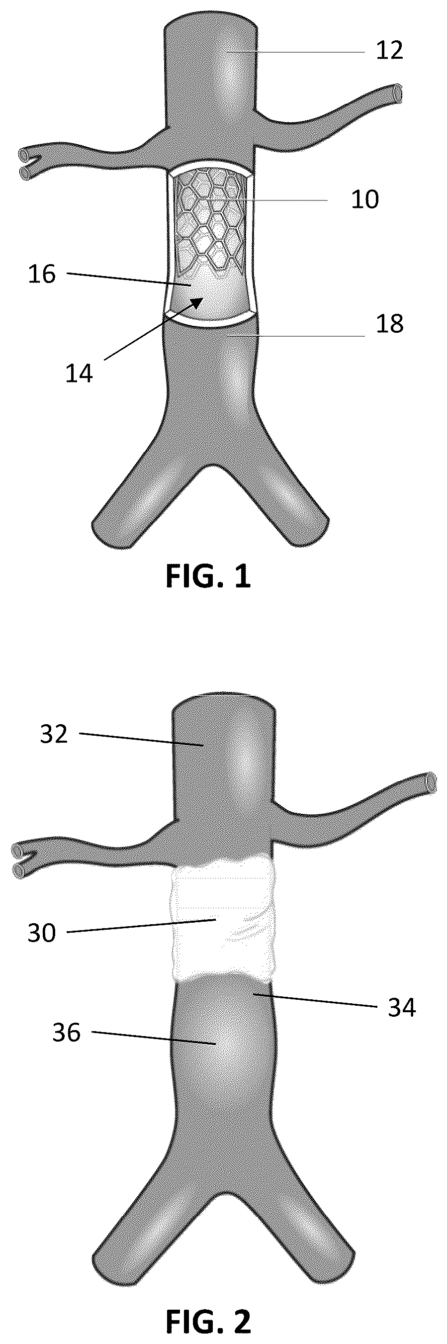 Patent US12097135 Figure 1 – Methods, devices, and compositions for treating vascular aneurysms