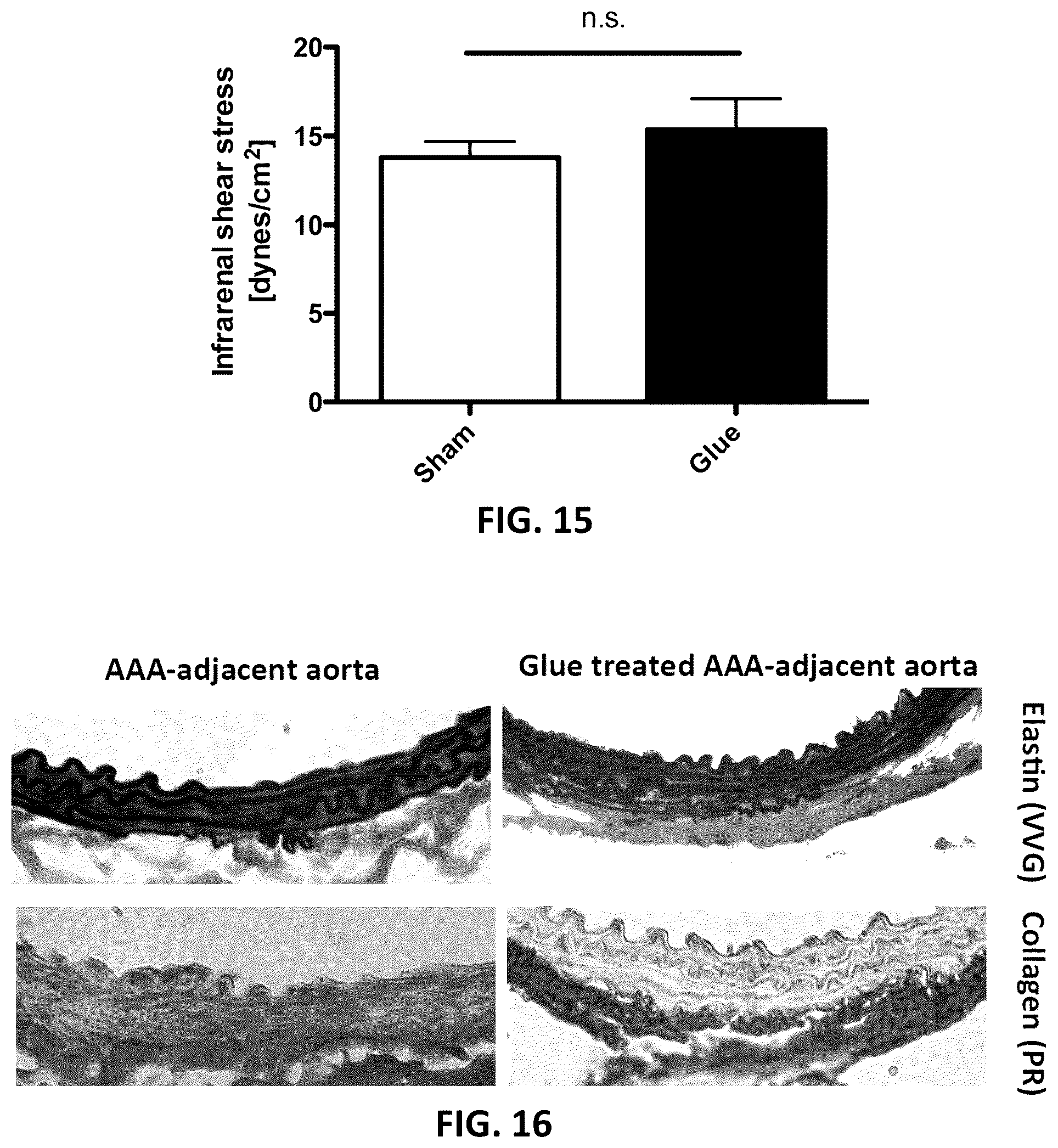 Patent US12097135 Figure 14 – Methods, devices, and compositions for treating vascular aneurysms
