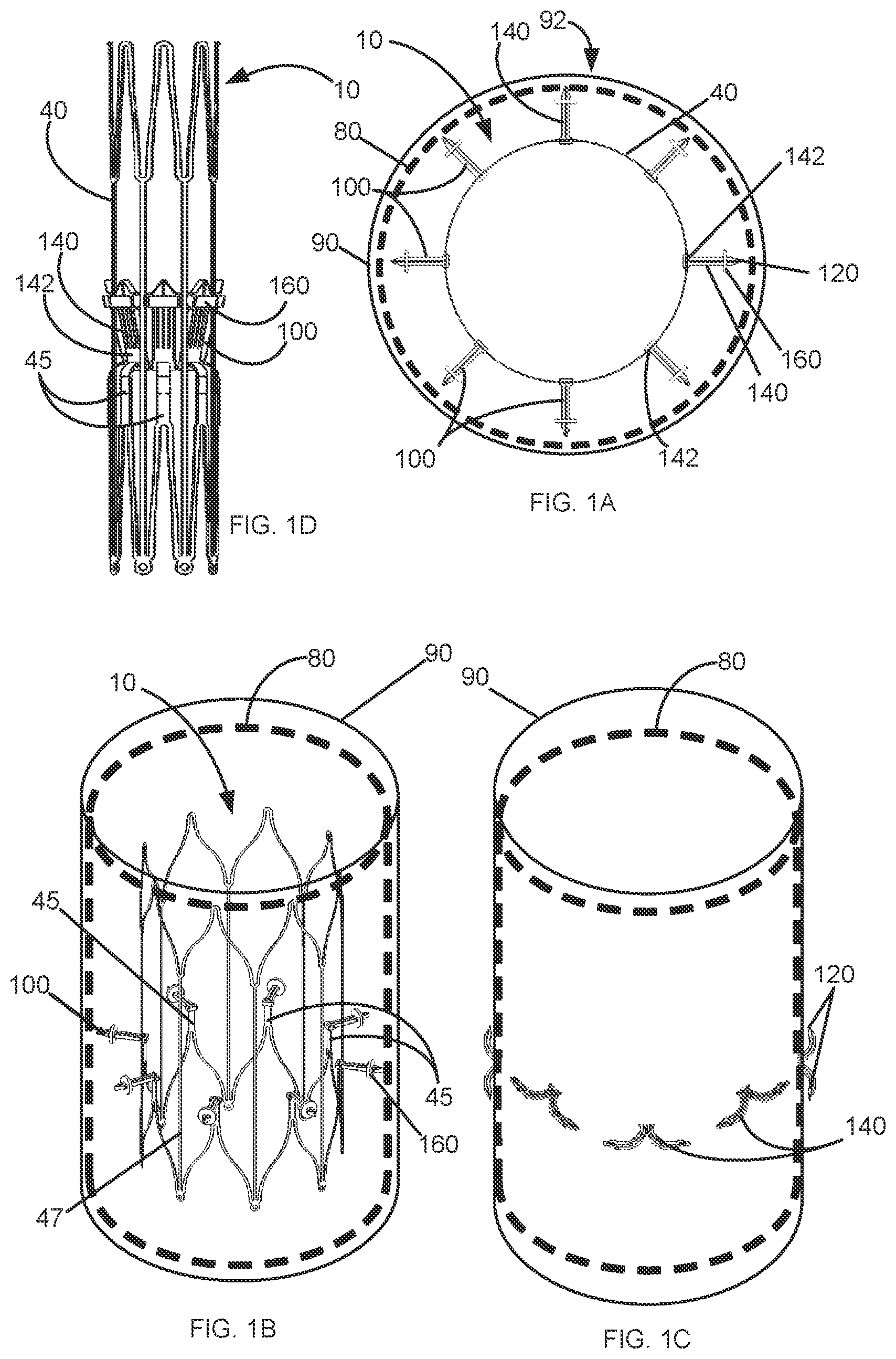 Patent US12097136 Figure 1 – Graft securing system, applicator and method