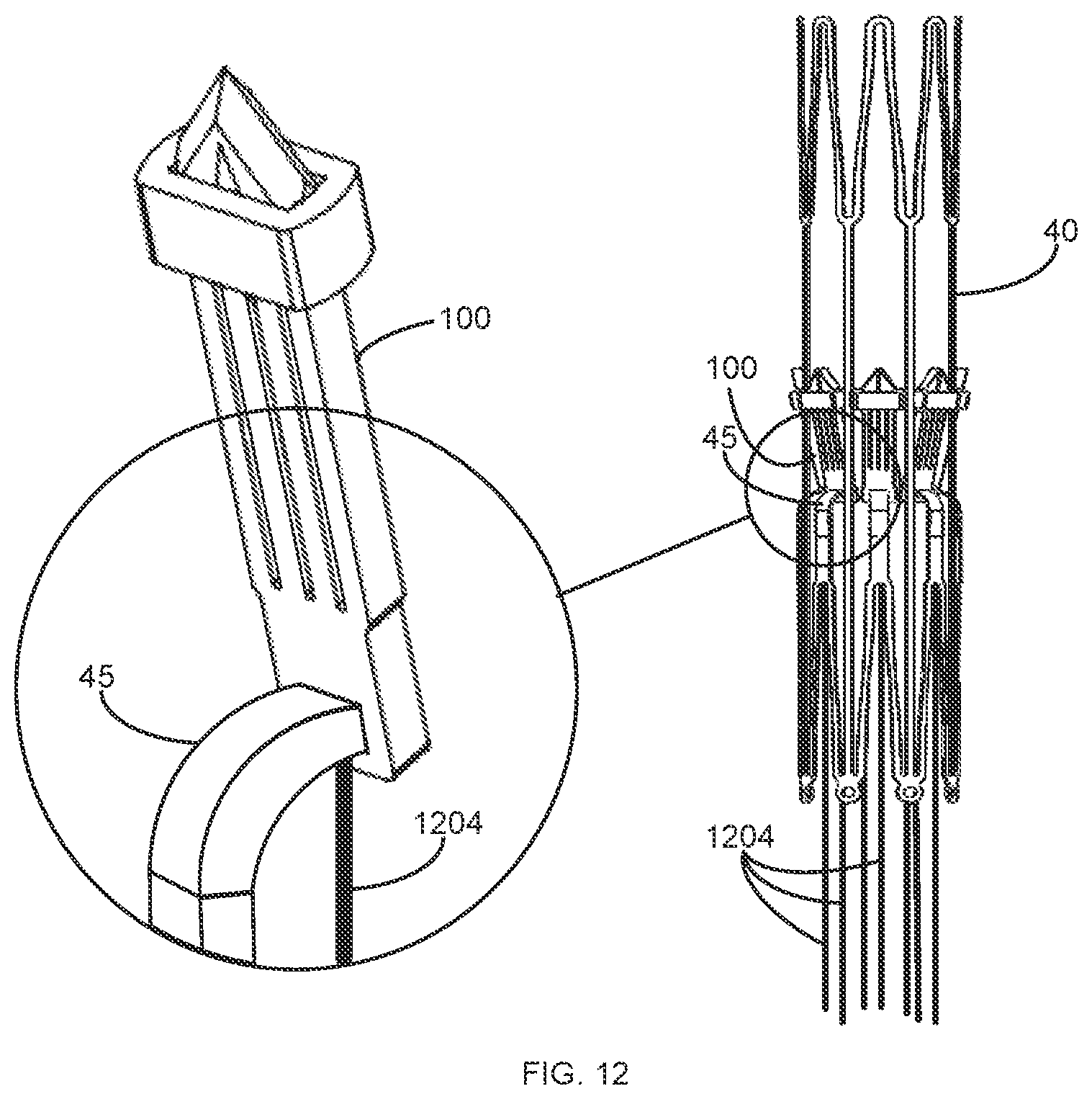 Patent US12097136 Figure 11 – Graft securing system, applicator and method
