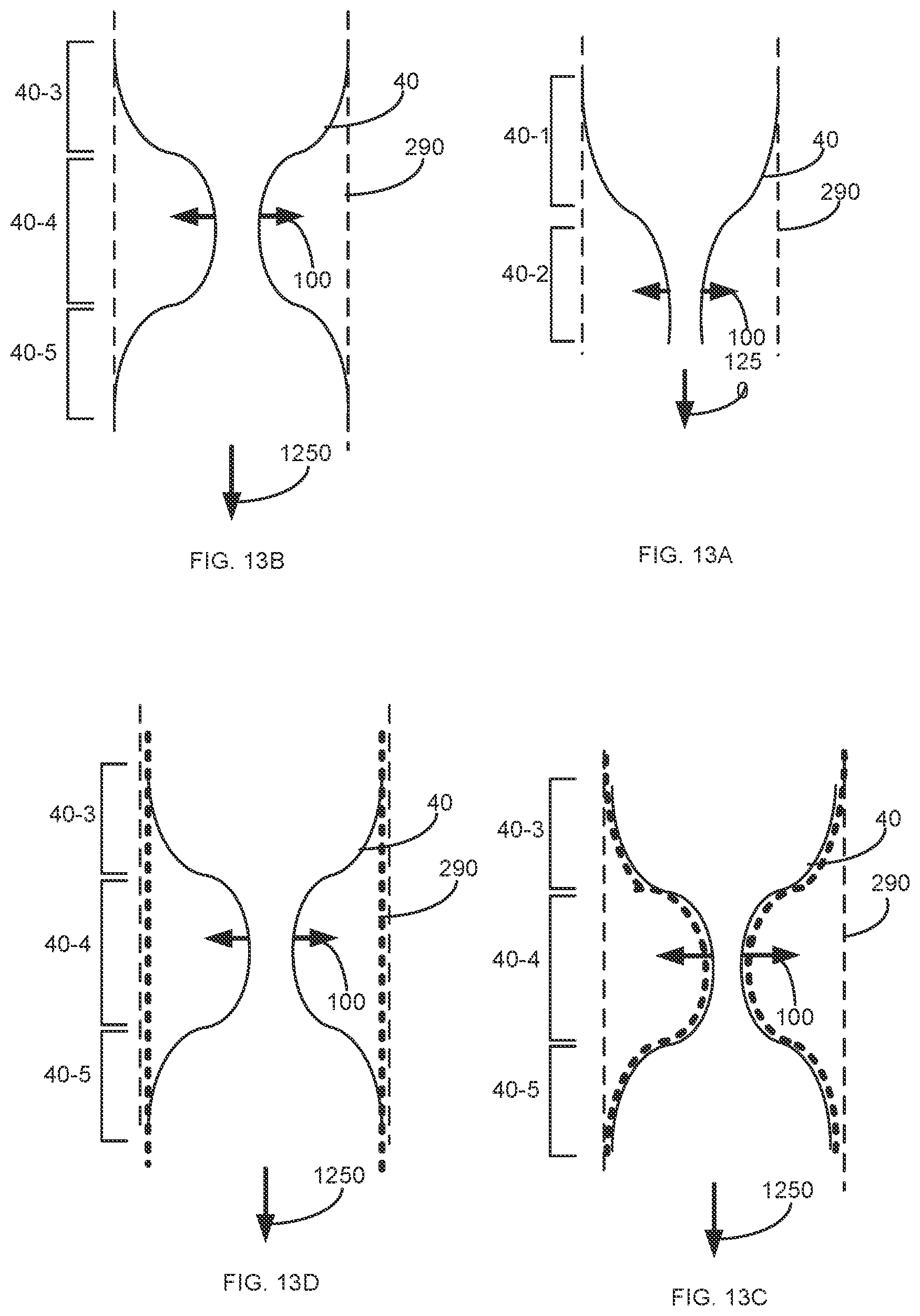 Patent US12097136 Figure 12 – Graft securing system, applicator and method