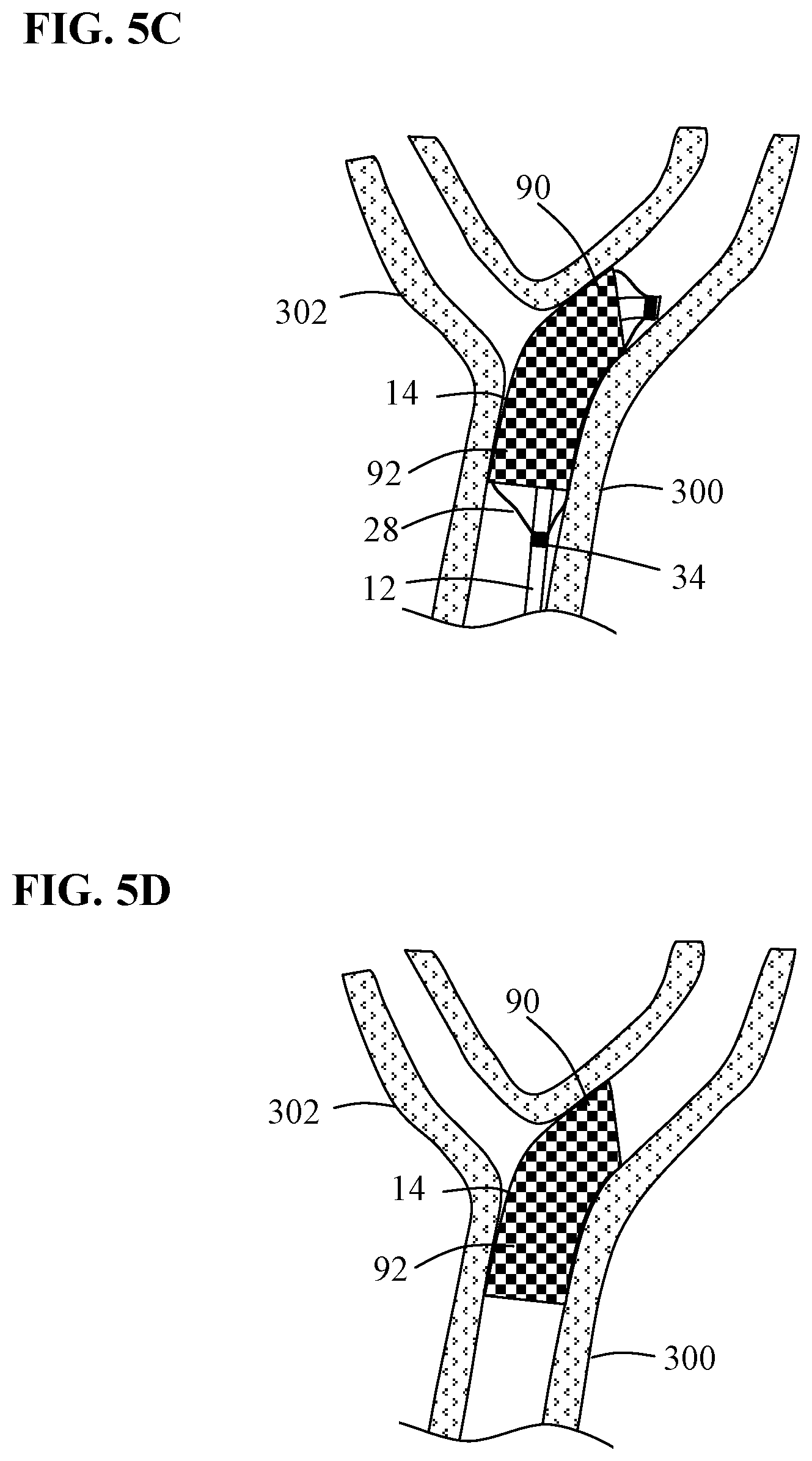 Patent US12097137 Figure 8 – Systems and methods for intravascular procedures