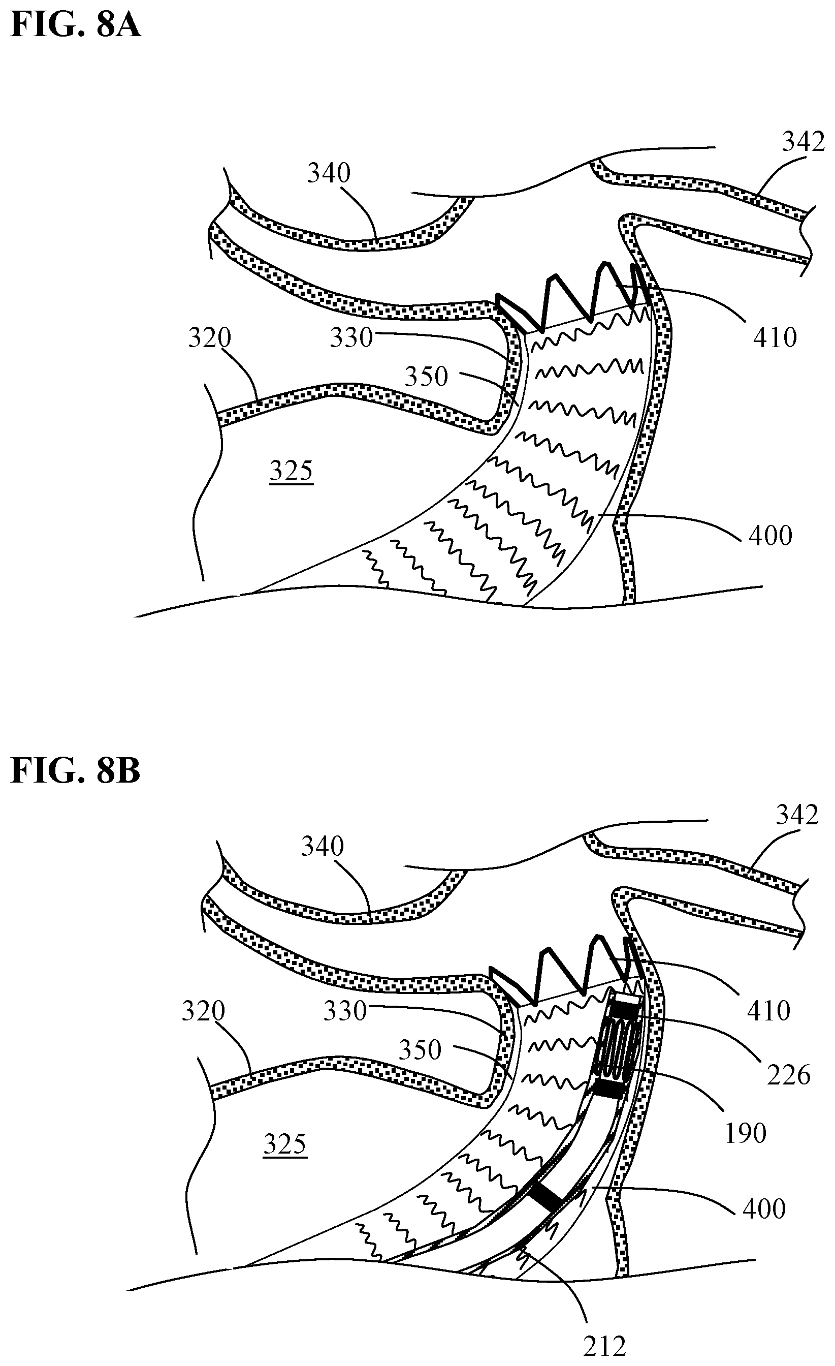 Patent US12097137 Figure 10 – Systems and methods for intravascular procedures