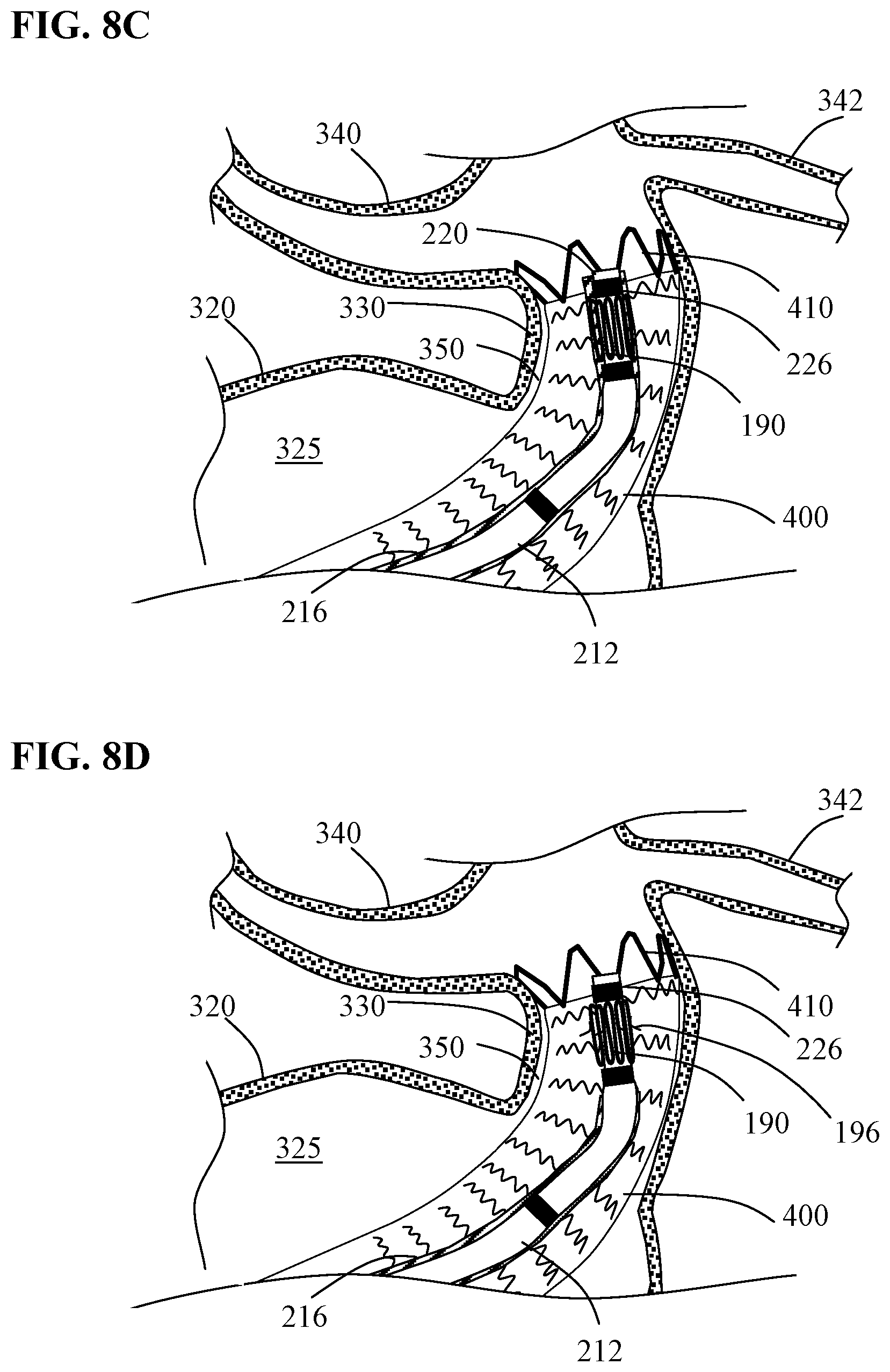 Patent US12097137 Figure 11 – Systems and methods for intravascular procedures
