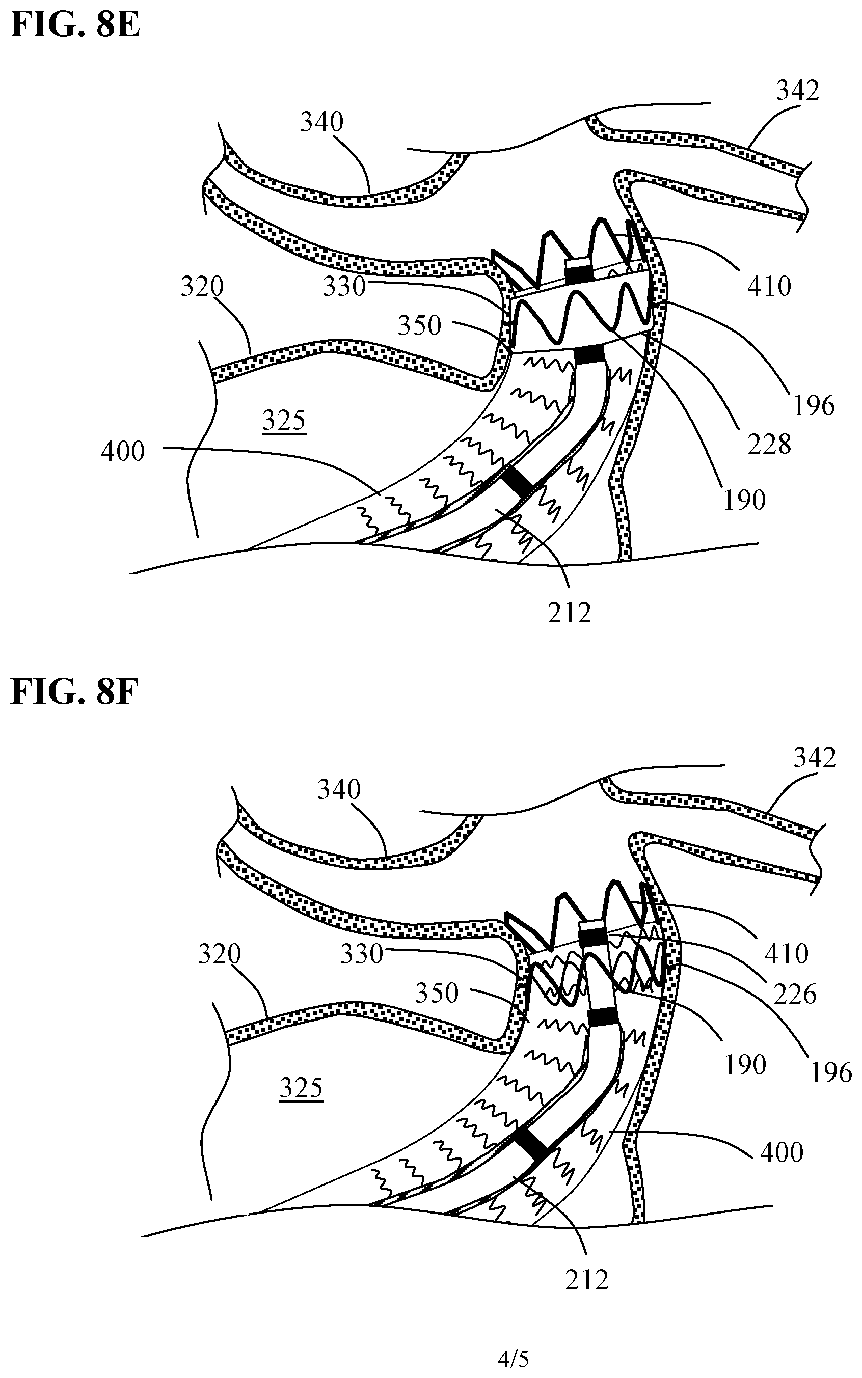 Patent US12097137 Figure 12 – Systems and methods for intravascular procedures