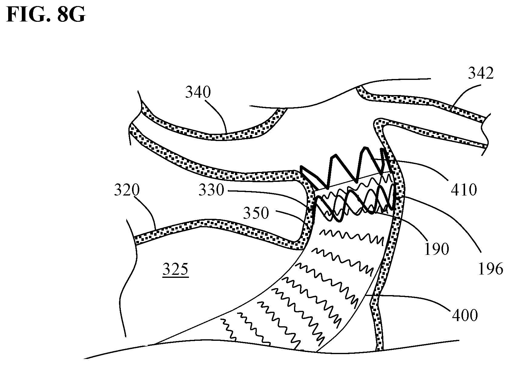 Patent US12097137 Figure 13 – Systems and methods for intravascular procedures