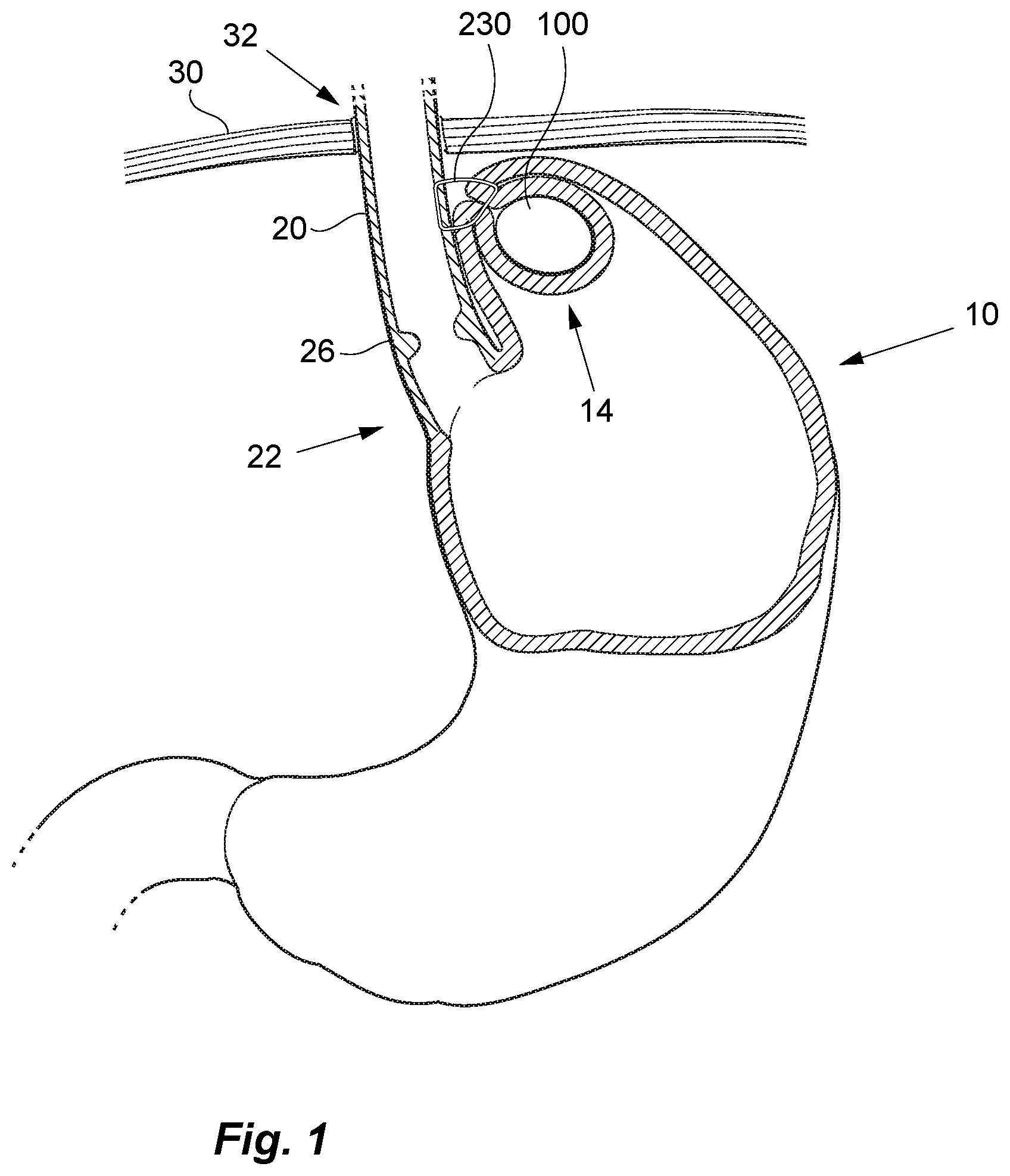 Patent US12097138 Figure 1 – Treatment of GERD