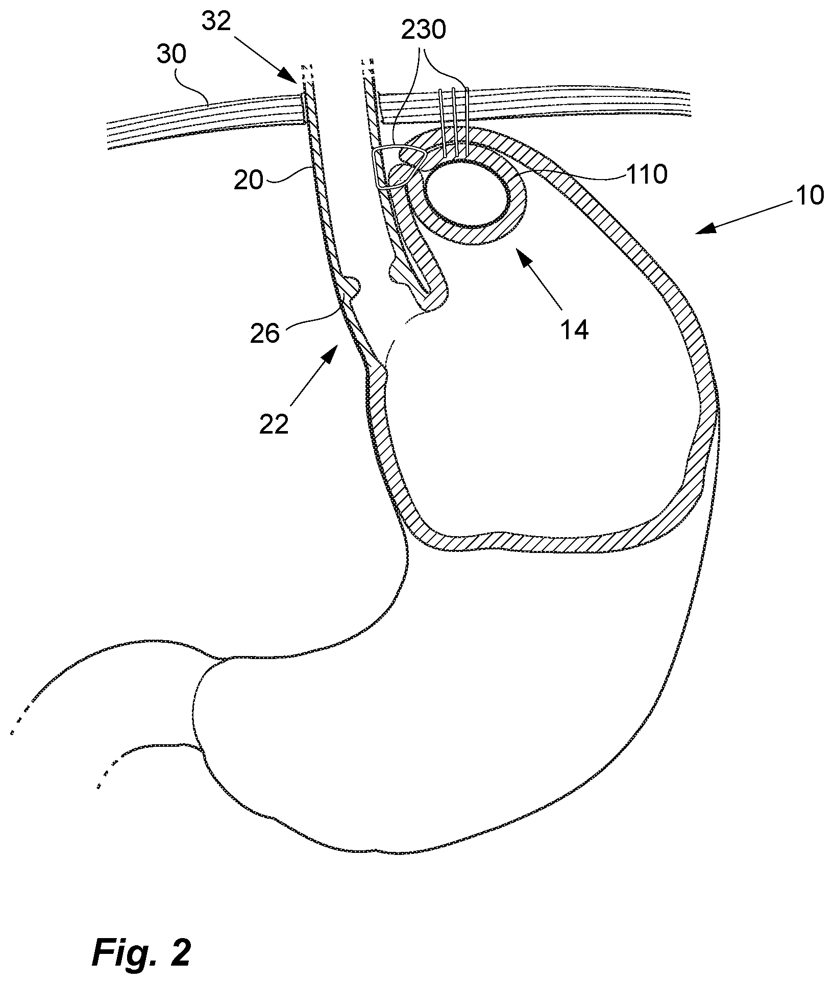 Patent US12097138 Figure 2 – Treatment of GERD