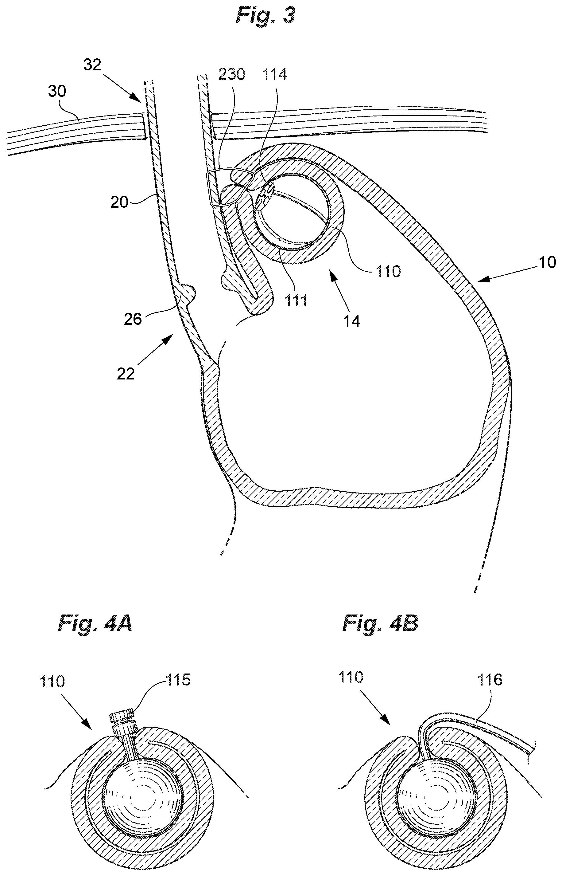Patent US12097138 Figure 3 – Treatment of GERD
