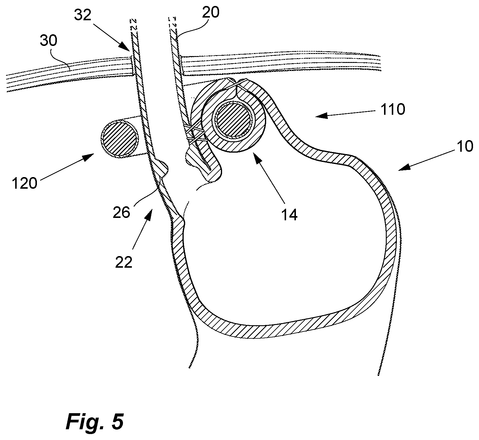 Patent US12097138 Figure 4 – Treatment of GERD